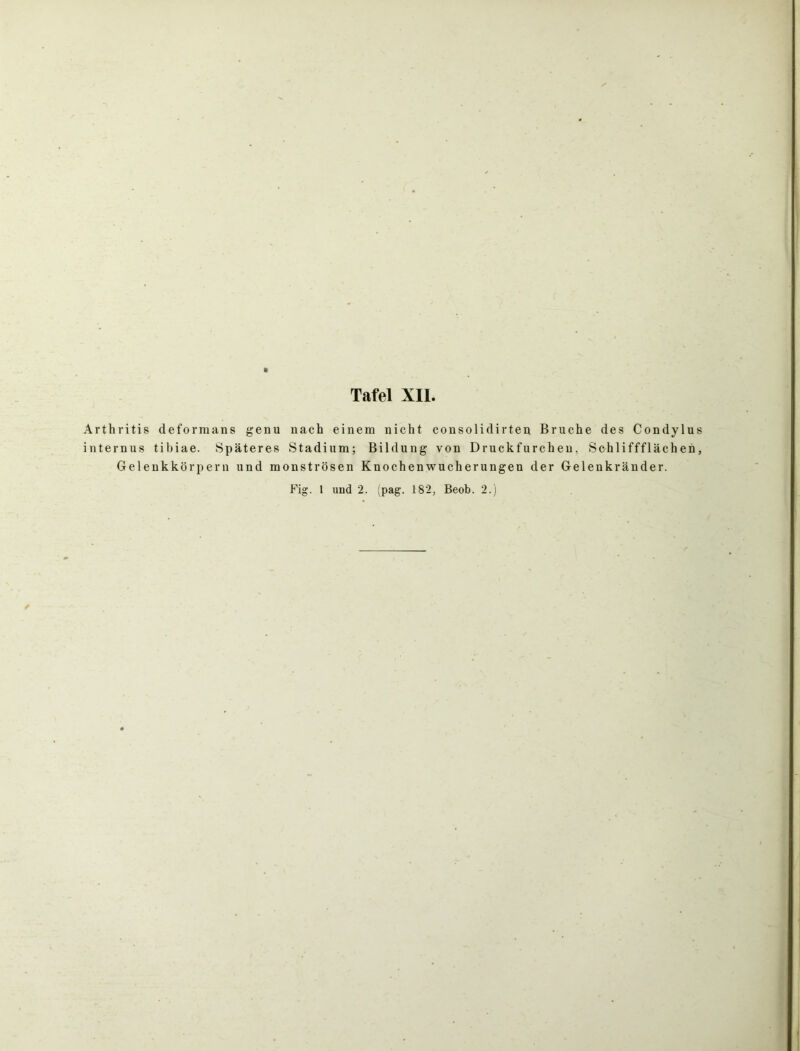 Arthritis deformans genu nach einem nicht consolidirten Bruche des Condylus internus tibiae. Späteres Stadium; Bildung von Druckfurchen, Schliffflächen, Gelenkkörpern und monströsen Knochenwucherungen der Gelenkränder.