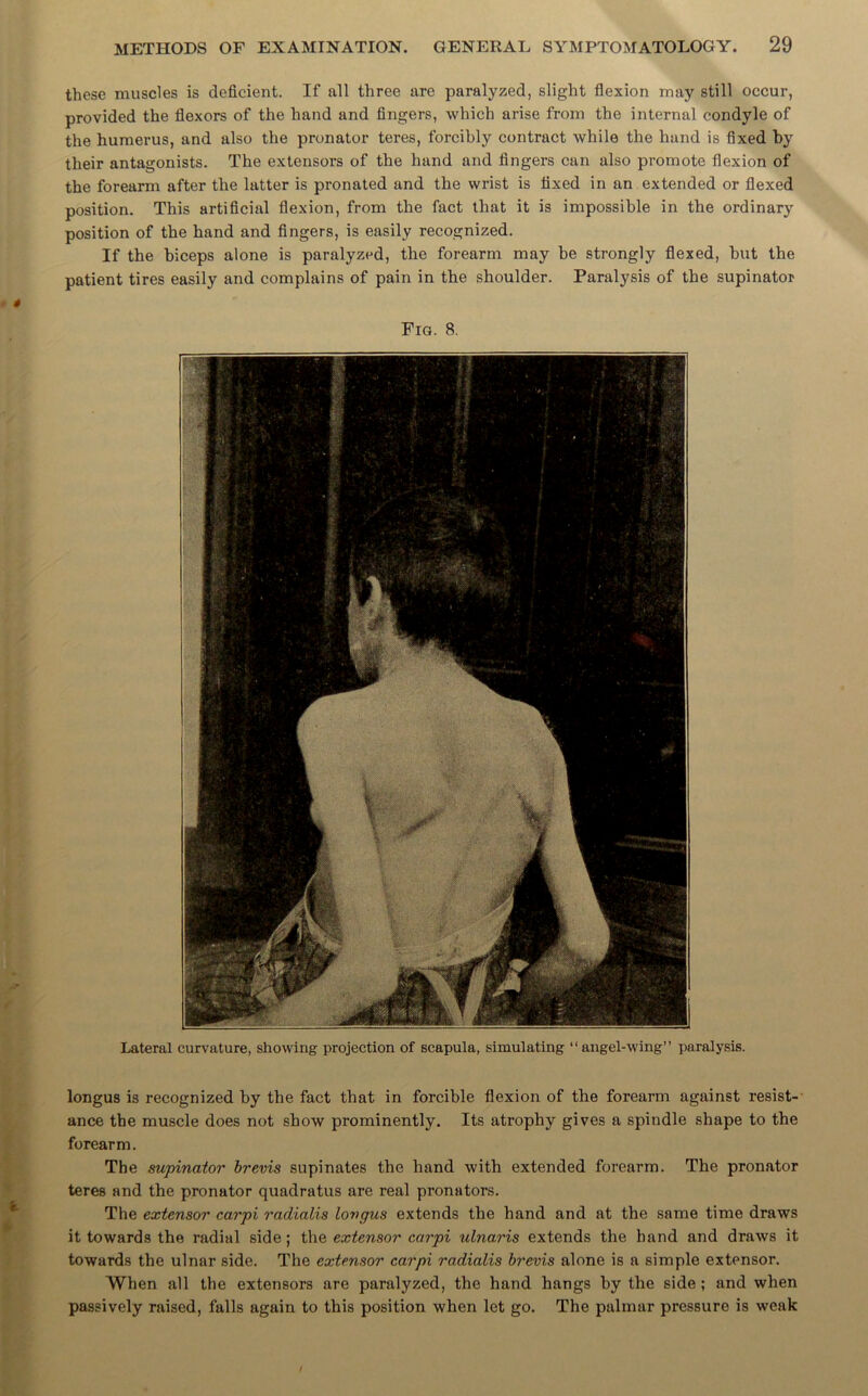 these muscles is deficient. If all three are paralyzed, slight flexion may still occur, provided the flexors of the hand and fingers, which arise from the internal condyle of the humerus, and also the pronator teres, forcibly contract while the hand is fixed by their antagonists. The extensors of the hand and fingers can also promote flexion of the forearm after the latter is pronated and the wrist is fixed in an extended or flexed position. This artificial flexion, from the fact that it is impossible in the ordinary position of the hand and fingers, is easily recognized. If the biceps alone is paralyzed, the forearm may be strongly flexed, but the patient tires easily and complains of pain in the shoulder. Paralysis of the supinator Fig. 8. longus is recognized by the fact that in forcible flexion of the forearm against resist- ance the muscle does not show prominently. Its atrophy gives a spindle shape to the forearm. The supinator brevis supinates the hand with extended forearm. The pronator teres and the pronator quadratus are real pronators. The extensor carpi radialis longus extends the hand and at the same time draws it towards the radial side; the extensor carpi ulnaris extends the hand and draws it towards the ulnar side. The extensor carpi radialis brevis alone is a simple extensor. When all the extensors are paralyzed, the hand hangs by the side ; and when passively raised, falls again to this position when let go. The palmar pressure is weak Lateral curvature, showing projection of scapula, simulating “angel-wing” paralysis.