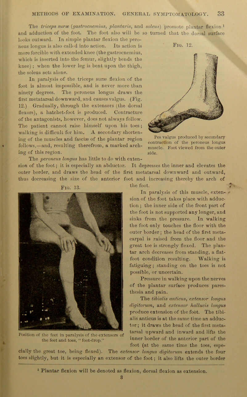 Fig. 12. Pes valgus produced by secondary contraction of the peroneus longus muscle. Foot viewed from the outer side. thus decreasing the size of the anterior Fig. 13. The triceps surse (gastrocnemius, plantar is, and soleus) promote plantar flexion 1 and adduction of the foot. The foot also will be so turned that the dorsal surface looks outward. In simple plantar flexion the pero- neus longus is also ealh-d into action. Its action is more forcible with extended knee (the gastrocnemius, which is inserted into the femur, slightly bends the knee) ; when the lower leg is bent upon the thigh, the soleus acts alone. In paralysis of the triceps surae flexion of the foot is almost impossible, and is never more than ninety degrees. The peroneus longus draws the first metatarsal downward, and causes valgus. (Fig. 12.) Gradually, through the extensors (the dorsal flexors), a liatchet-foot is produced. Contracture of the antagonists, however, does not always follow. The patient cannot raise himself upon his toes; walking is difficult for him. A secondary shorten- ing of the muscles and fasciae of the plantar region follows,—and, resulting therefrom, a marked arch- ing of this region. The peroneus longus has little to do with exten- sion of the foot; it is especially an abductor. It depresses the inner and elevates the outer border, and draws the head of the first metatarsal downward and outward, foot and increasing thereby the arch of the foot. In paralysis of this muscle, exten- sion of the foot takes place with adduc- tion ; the inner side of the front part of the foot is not supported any longer, and sinks from the pressure. In walking the foot only touches the floor with the outer border; the head of the first meta- carpal is raised from the floor and the great toe is strongly flexed. The plan- tar arch decreases from standing, a flat- foot condition resulting. Walking is fatiguing; standing on the toes is not possible, or uncertain. Pressure in walking upon the nerves of the plantar surface produces pares- thesia and pain. The tibialis anticus, extensor longus digitorum, and extensor hallucis longus produce extension of the foot. The tibi- alis anticus is at the same time an adduc- tor; it draws the head of the first meta- tarsal upward and inward and lifts the inner border of the anterior part of the foot (at the same time the toes, espe- cially the great toe, being flexed). The extensor longus digitorum extends the four toes slightly, but it is especially an extensor of the foot; it also lifts the outer border Position of the feet in paralysis of the extensors of the feet and toes, “ foot-drop.” 1 Plantar flexion will be denoted as flexion, dorsal flexion as extension. 3