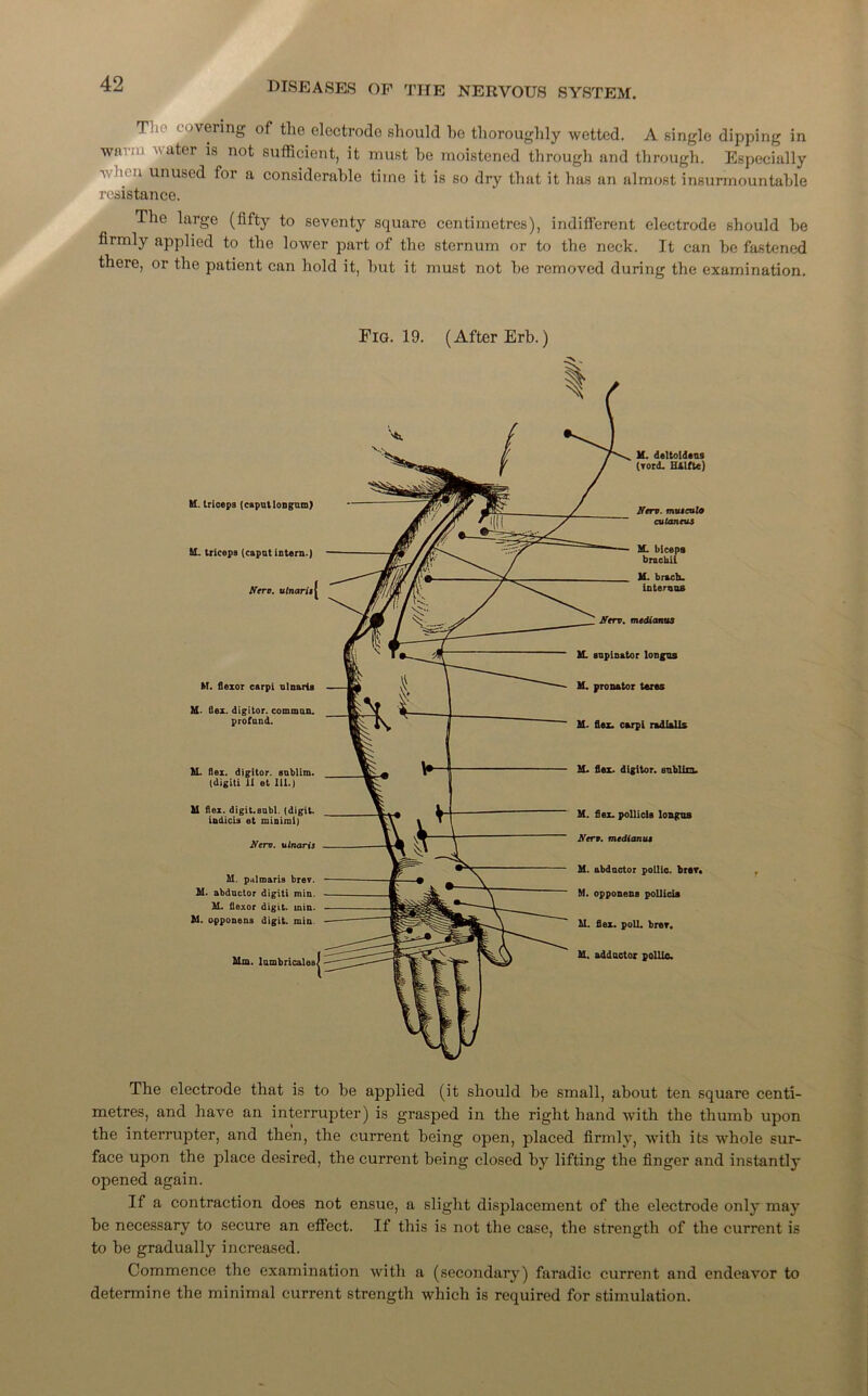 T <vering of the electrode should he thoroughly wetted. A single dipping in wnvi.i water is not sufficient, it must he moistened through and through. Especially v in'u unused for a considerable time it is so dry that it has an almost insurmountable resistance. The large (fifty to seventy square centimetres), indifferent electrode should he firmly applied to the lower part of the sternum or to the neck. It can he fastened there, or the patient can hold it, hut it must not he removed during the examination. Fig. 19. (After Erh.) M. triceps (caput Iongum) M. triceps (caput intern.) AVrc. ulnarii { M. flexor carpi ulnaris M- flex, digitor. common, profund. M. flex, digitor. snblim. (digiti ii et 111.) M flex. digit.8ubl. (digit, indicia et minimi) Ncrv. ulnaris M. p.ilmaris brev. M. abductor digiti min. M. flexor digit, min. M. opponena digit, min. Mm. lumbricales ( M. deltoldeus (Tord. HAlfte) M. flex, digitor. snblim. M. flex, pollicis longus Nerv. medianut M. abductor pollic. brer. M. opponens pollicis M. flex. poll. brer. M, adductor pollie. Ncrv. muicuta cutancui M. biceps bracbii U. brach. interuus Ncrv. medianus U. supinator longus M. pronator teres U. flex, carpi radlalls The electrode that is to he applied (it should be small, about ten square centi- metres, and have an interrupter) is grasped in the right hand with the thumb upon the interrupter, and then, the current being open, placed firmly, with its whole sur- face upon the place desired, the current being closed by lifting the finger and instantly opened again. If a contraction does not ensue, a slight displacement of the electrode only may be necessary to secure an effect. If this is not the case, the strength of the current is to he gradually increased. Commence the examination with a (secondary) faradic current and endeavor to determine the minimal current strength which is required for stimulation.