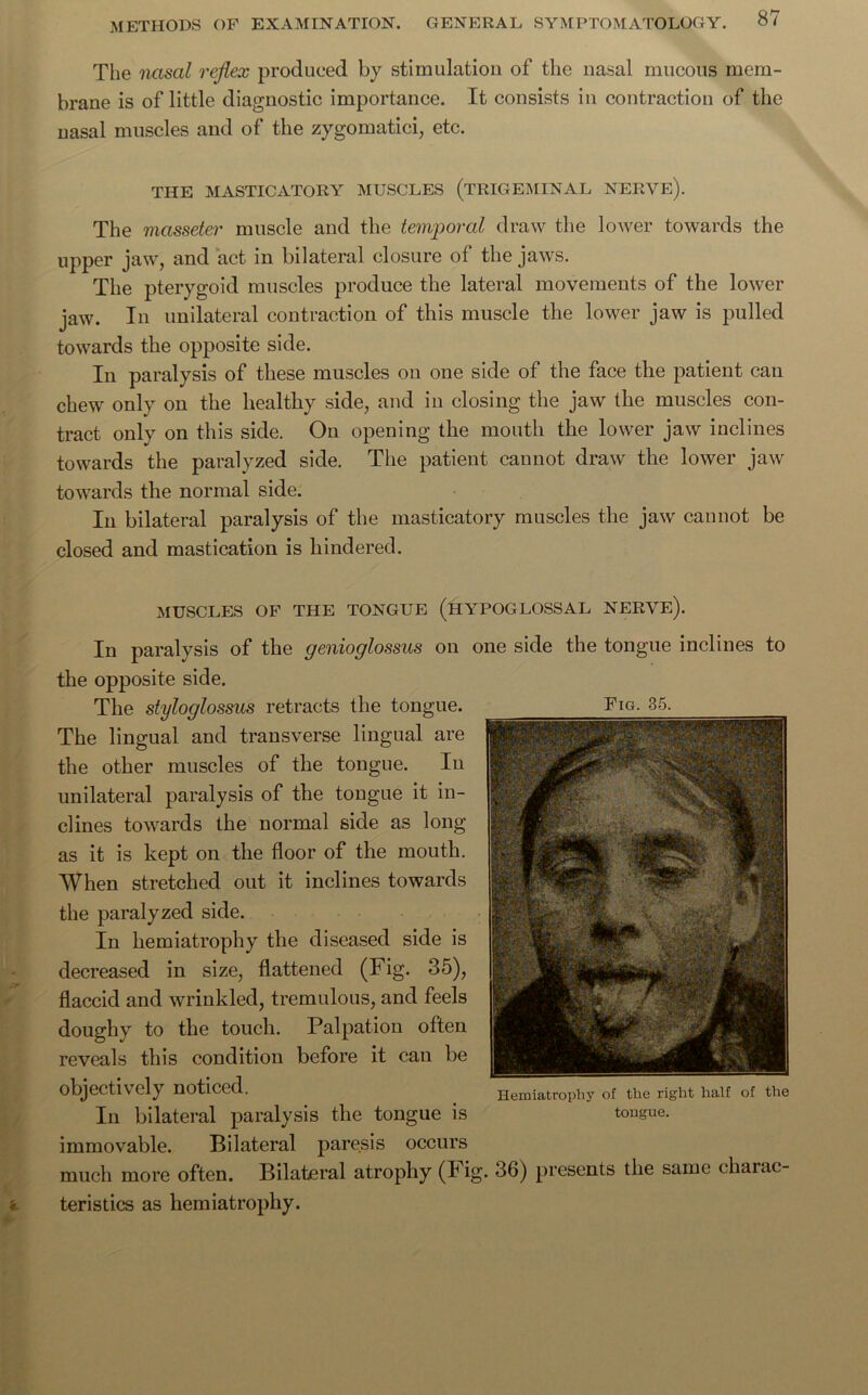 The nasal reflex produced by stimulation of the nasal mucous mem- brane is of little diagnostic importance. It consists in contraction of the nasal muscles and of the zygomatici, etc. THE MASTICATORY MUSCLES (TRIGEMINAL NERVE). The masseter muscle and the temporal draw the lower towards the upper jaw, and act in bilateral closure of the jaws. The pterygoid muscles produce the lateral movements of the lower jaw. In unilateral contraction of this muscle the lower jaw is pulled towards the opposite side. In paralysis of these muscles on one side of the face the patient can chew only on the healthy side, and in closing the jaw the muscles con- tract only on this side. On opening the mouth the lower jaw inclines towards the paralyzed side. The patient cannot draw the lower jaw towards the normal side. In bilateral paralysis of the masticatory muscles the jaw cannot be closed and mastication is hindered. Fig. 35. MUSCLES OF THE TONGUE (HYPOGLOSSAL NERVE). In paralysis of the genioglossus on one side the tongue inclines to the opposite side. The styloglossus retracts the tongue. The lingual and transverse lingual are the other muscles of the tongue. In unilateral paralysis of the tongue it in- clines towards the normal side as long as it is kept on the floor of the mouth. When stretched out it inclines towards the paralyzed side. In hemiatrophy the diseased side is decreased in size, flattened (Fig. 35), flaccid and wrinkled, tremulous, and feels doughy to the touch. Palpation often reveals this condition before it can be objectively noticed. In bilateral paralysis the tongue is immovable. Bilateral paresis occurs much more often. Bilateral atrophy (Fig. 36) presents the same charac- teristics as hemiatrophy. Hemiatrophy of the right half of the tongue.