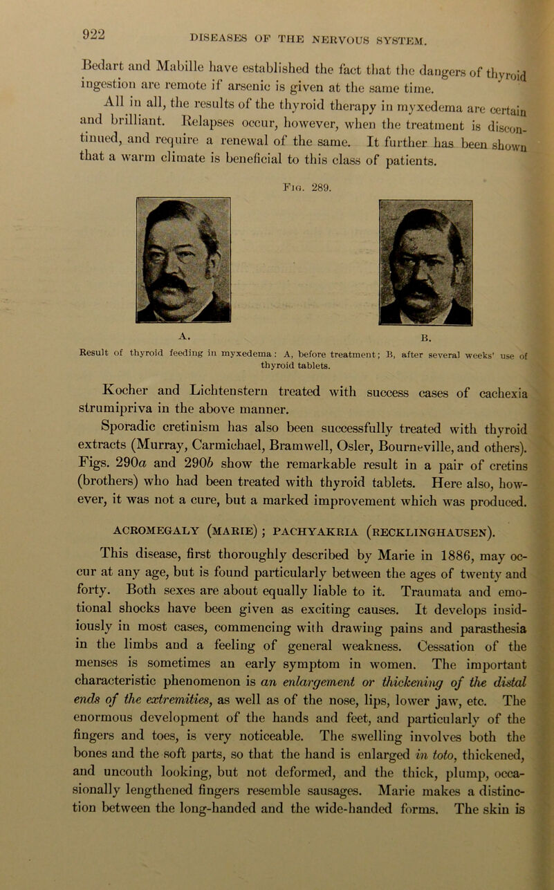 Bedart and Mabille ]iave established the fact that the dangers of thyroid ingestion are remote if arsenic is given at the same time. All in all, the results of the thyroid therapy in myxedema are certain and brilliant. Relapses occur, however, when the treatment is discon- tinued, and require a renewal of the same. It further has been shown that a warm climate is beneficial to this class of patients. Fjo. 289. B. Result of thyroid feeding in myxedema: A, before treatment; B, after several weeks' use of thyroid tablets. Kocher and Lichtenstern treated with success cases of cachexia strumipriva in the above manner. Sporadic cretinism has also been successfully treated with thyroid extracts (Murray, Carmichael, Bramwell, Osier, Bourneville, and others). Figs. 290a and 2906 show the remarkable result in a pair of cretins (brothers) who had been treated with thyroid tablets. Here also, how- ever, it was not a cure, but a marked improvement which was produced. ACROMEGALY (MARIE) ; PACHYAKRIA (RECKLINGHAUSEN). This disease, first thoroughly described by Marie in 1886, may oc- cur at any age, but is found particularly between the ages of twenty and forty. Both sexes are about equally liable to it. Traumata and emo- tional shocks have been given as exciting causes. It develops insid- iously in most cases, commencing with drawing pains and parasthesia in the limbs and a feeling of general weakness. Cessation of the menses is sometimes an early symptom in women. The important characteristic phenomenon is an enlargement or thickening of the distal ends of the extremities, as well as of the nose, lips, lower jaw, etc. The enormous development of the hands and feet, and particularly of the fingers and toes, is very noticeable. The swelling involves both the bones and the soft parts, so that the hand is enlarged in toto, thickened, and uncouth looking, but not deformed, and the thick, plump, occa- sionally lengthened fingers resemble sausages. Marie makes a distinc- tion between the long-handed and the wide-handed forms. The skin is