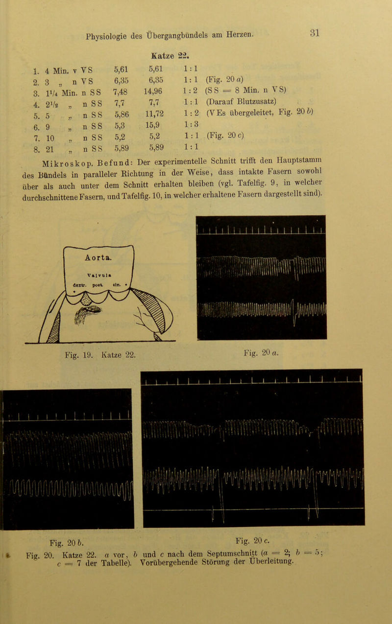 Katze 22 1. 4 Min. v VS 5,61 5,61 2. 3 „ n v; S 6,35 6,35 3. V-U Min. n SS 7,48 14,96 4. 2V« „ n SS 7,7 7,7 5. 5 » n SS 5,86 11,72 6. 9 „ n SS 5,3 15,9 7. 10 „ n SS 5,2 5,2 8. 21 „ n SS 5,89 5,89 1:1 1: 1 (Fig. 20 a) 1:2 (S S = 8 Min. n V S) 1:1 (Darauf Blutznsatz) 1:2 (V Es übergeleitet, Fig. 20 b) 1:3 1:1 (Fig. 20 c) 1:1 Mikroskop. Befund: Der experimentelle Schnitt trifft den Hauptstamm des Bündels in paralleler Richtung in der Weise, dass intakte Fasern sowohl über als auch unter dem Schnitt erhalten bleiben (vgl. Tafelfig. 9, in welcher durchschnittene Fasern, und Tafelfig. 10, in welcher erhaltene Fasern dargestellt sind). Fig. 20 b. Fig. 20 c. t Fm. 20. Katze 22. a vor, b und c nach dem Septumschnitt (a = 2; b = 5; c = 7 der Tabelle). Vorübergehende Störung der Überleitung.