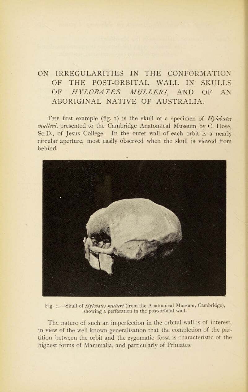 OF THE POST-ORBITAL WALL IN SKULLS OF HYLOBATES MULLER!, AND OF AN ABORIGINAL NATIVE OF AUSTRALIA. The first example (fig. i) is the skull of a specimen of Hylobates mulleri, presented to the Cambridge Anatomical Museum by C. Hose, Sc.D., of Jesus College. In the outer wall of each orbit is a nearly circular aperture, most easily observed when the skull is viewed from behind. Fig. i.—Skull of Hylobates mulleri (from the Anatomical Museum, Cambridge), showing a perforation in the post-orbital wall. The nature of such an imperfection in the orbital wall is of interest, in view of the well known generalisation that the completion of the par- tition between the orbit and the zygomatic fossa is characteristic of the highest forms of Mammalia, and particularly of Primates.