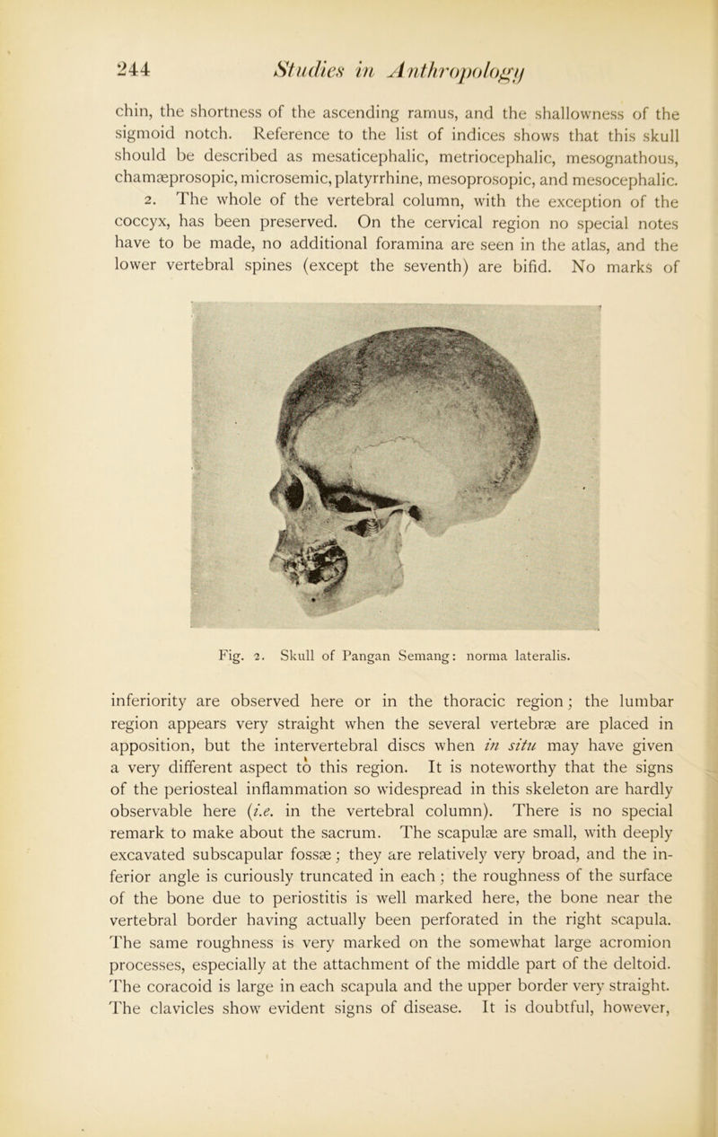 chin, the shortness of the ascending ramus, and the shallowness of the sigmoid notch. Reference to the list of indices shows that this skull should be described as mesaticephalic, metriocephalic, mesognathous, chamseprosopic, microsemic, platyrrhine, mesoprosopic, and mesocephalic. 2. The whole of the vertebral column, with the exception of the coccyx, has been preserved. On the cervical region no special notes have to be made, no additional foramina are seen in the atlas, and the lower vertebral spines (except the seventh) are bifid. No marks of Fig. 2. Skull of Pangan Semang: norma lateralis. inferiority are observed here or in the thoracic region; the lumbar region appears very straight when the several vertebrae are placed in apposition, but the intervertebral discs when in situ may have given a very different aspect to this region. It is noteworthy that the signs of the periosteal inflammation so widespread in this skeleton are hardly observable here (i.e. in the vertebral column). There is no special remark to make about the sacrum. The scapulae are small, with deeply excavated subscapular fossae; they are relatively very broad, and the in- ferior angle is curiously truncated in each; the roughness of the surface of the bone due to periostitis is well marked here, the bone near the vertebral border having actually been perforated in the right scapula. The same roughness is very marked on the somewhat large acromion processes, especially at the attachment of the middle part of the deltoid. The coracoid is large in each scapula and the upper border very straight. The clavicles show evident signs of disease. It is doubtful, however,