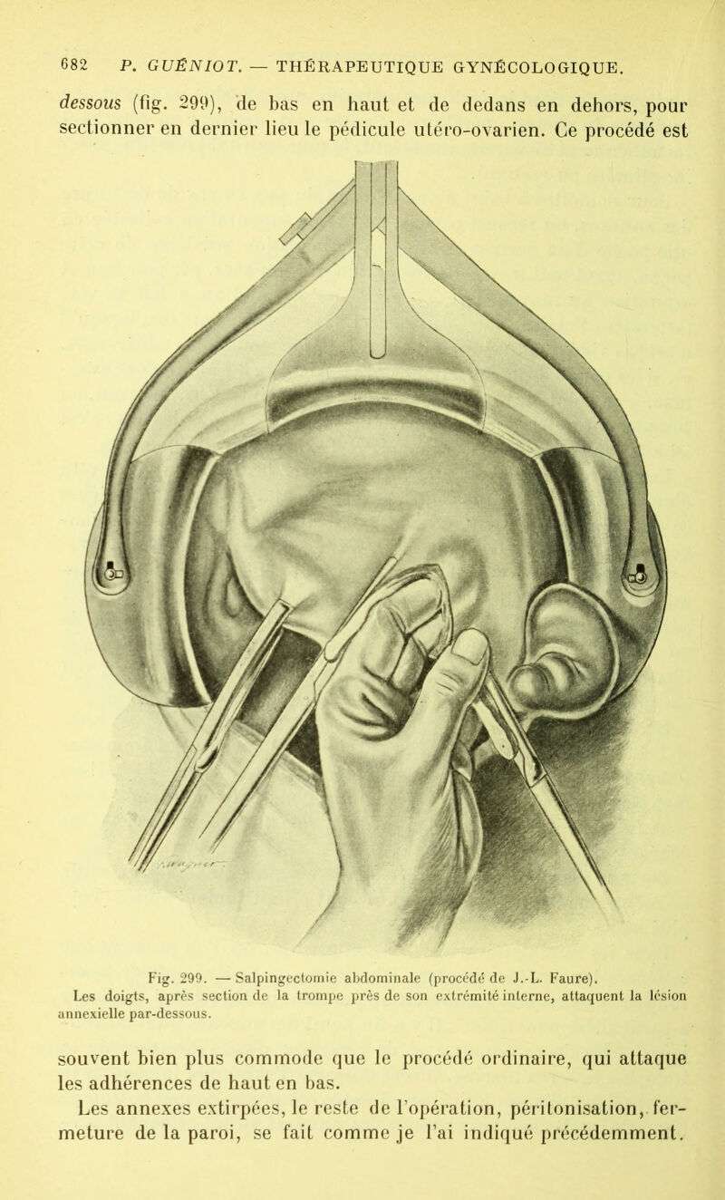 dessous (fig. 299), de bas en haut et de dedans en dehors, pour sectionner en dernier lieu le pédicule utéro-ovarien. Ce procédé est Fig. 299. — Salpingectomie abdominale (procédé de J.-L. Faure). Les doigts, après section de la trompe près de son extrémité interne, attaquent la lésion annexielle par-dessous. souvent bien plus commode que le procédé ordinaire, qui attaque les adhérences de haut en bas. Les annexes extirpées, le reste de l’opération, péritonisation, fer- meture de la paroi, se fait comme je l’ai indiqué précédemment.
