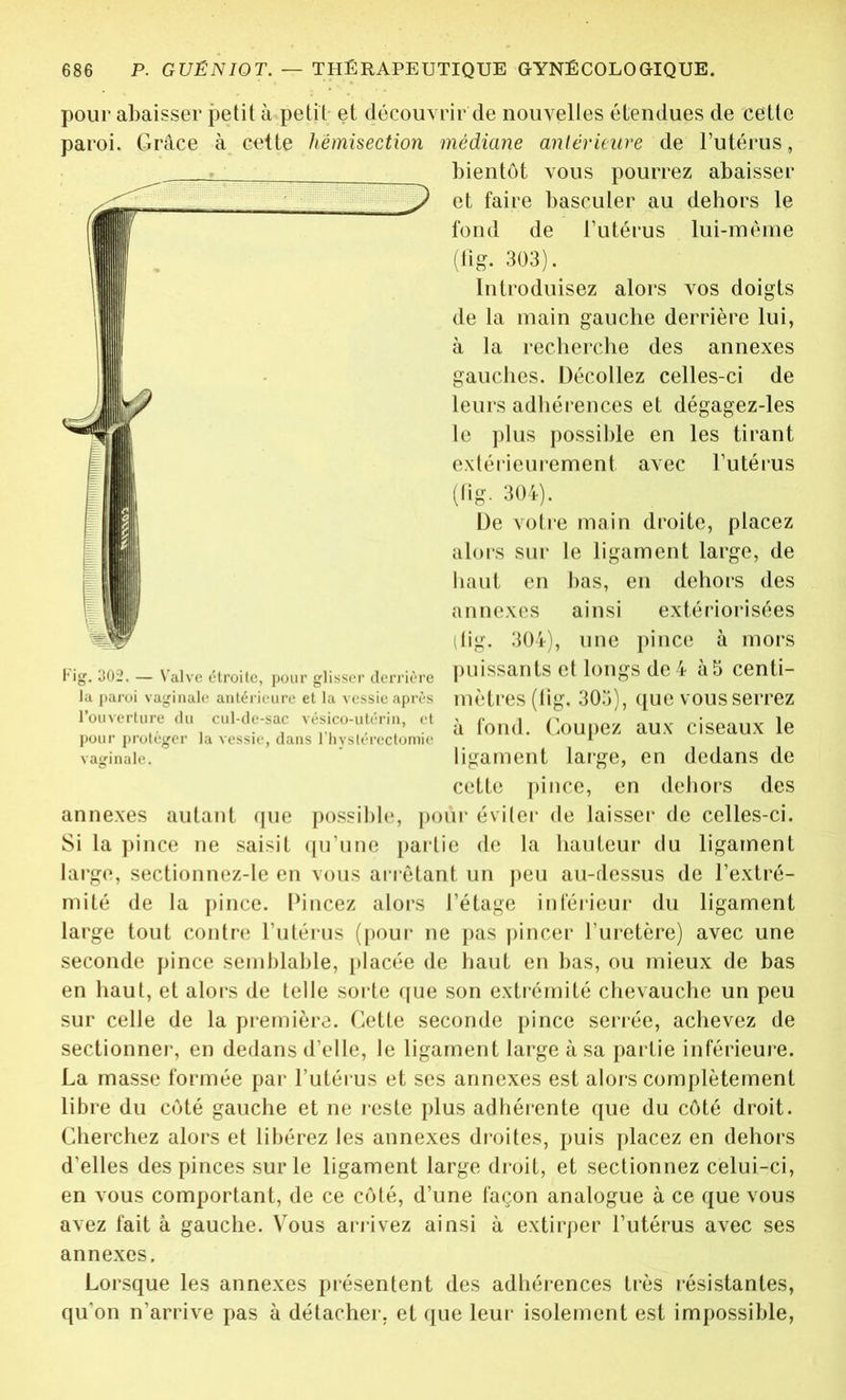 pour abaisser petit à petit et découvrir de nouvelles étendues de cette paroi. Grâce à cette hémisection médiane antérieure de l’utérus, bientôt vous pourrez abaisser et faire basculer au dehors le fond de l’utérus lui-même {fig. 303). Introduisez alors vos doigts de la main gauche derrière lui, à la recherche des annexes gauches. Décollez celles-ci de leurs adhérences et dégagez-les le plus possible en les tirant extérieurement avec l’utérus (fig. 304). De votre main droite, placez alors sur le ligament large, de haut en bas, en dehors des annexes ainsi extériorisées (lig. 304), une pince à mors puissants et longs de 4 à5 centi- mètres (fig. 305), que vous serrez à fond. Coupez aux ciseaux le ligament large, en dedans de cette pince, en dehors des annexes autant que possible, pour éviter de laisser de celles-ci. Si la pince ne saisit qu’une partie de la hauteur du ligament large, sectionnez-le en vous arrêtant un peu au-dessus de l’extré- mité de la pince. Pincez alors l’étage inférieur du ligament large tout contre l’utérus (pour ne pas pincer l’uretère) avec une seconde pince semblable, placée de haut en bas, ou mieux de bas en haut, et alors de telle sorte que son extrémité chevauche un peu sur celle de la première. Cette seconde pince serrée, achevez de sectionner, en dedans d’elle, le ligament large à sa partie inférieure. La masse formée par l’utérus et ses annexes est alors complètement libre du côté gauche et ne reste plus adhérente que du côté droit. Cherchez alors et libérez les annexes droites, puis placez en dehors d’elles des pinces sur le ligament large droit, et sectionnez celui-ci, en vous comportant, de ce côté, d’une façon analogue à ce que vous avez fait à gauche. Vous arrivez ainsi à extirper l’utérus avec ses annexes. Lorsque les annexes présentent des adhérences très résistantes, qu’on n’arrive pas à détacher, et que leur isolement est impossible, Fig. 302. — Valve étroite, pour glisser derrière lu paroi vaginale antérieure et la vessie après l’ouverture du cul-de-sac vésico-utérin, et pour protéger la vessie, dans l’hyslérectomie vaginale.