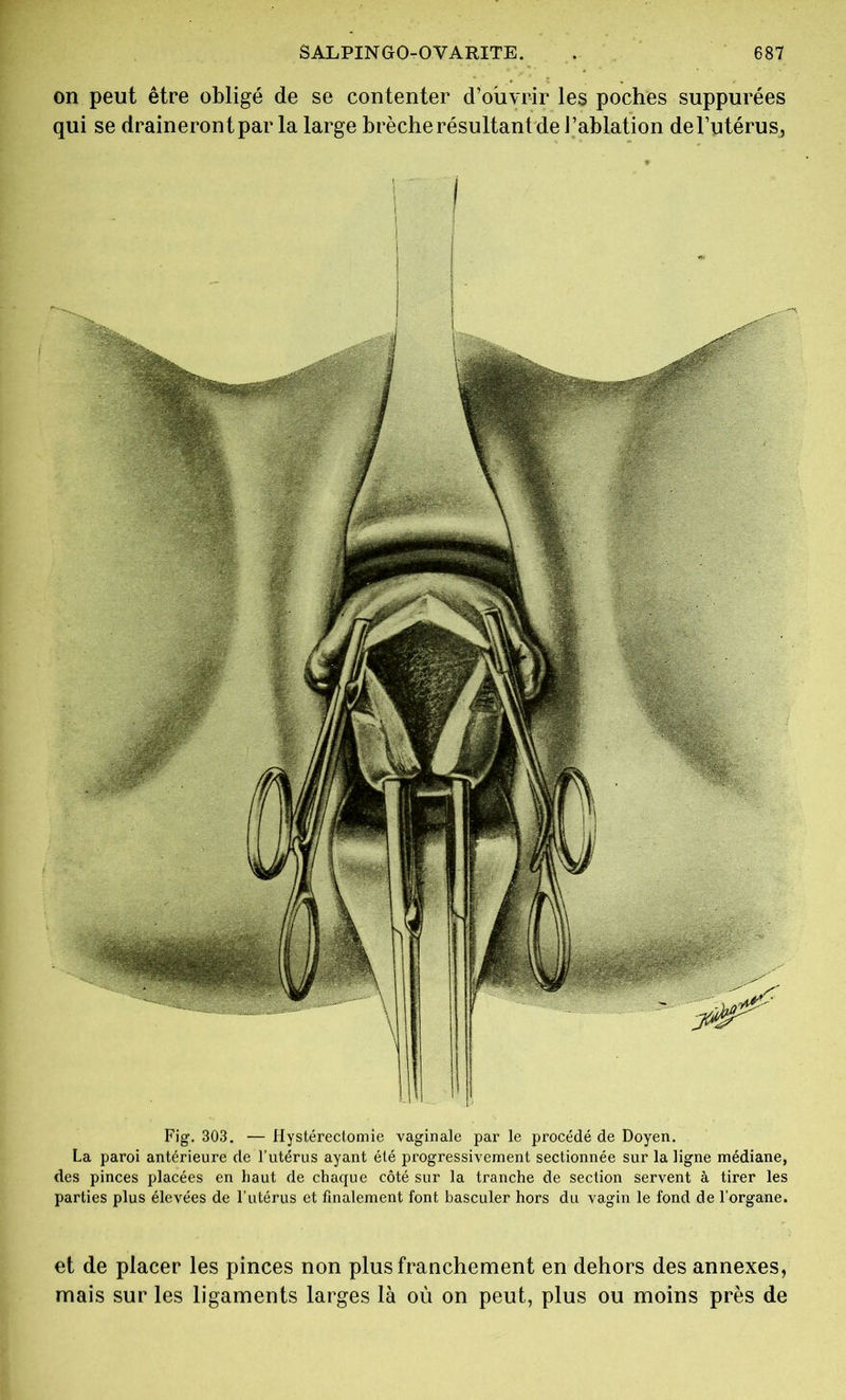 on peut être obligé de se contenter d’ouvrir les poches suppurées qui se draineront par la large brèche résultant de J’ablation de l’utérus, Fig. 303. — Hystérectomie vaginale par le procédé de Doyen. La paroi antérieure de l’utérus ayant été progressivement sectionnée sur la ligne médiane, des pinces placées en haut de chaque côté sur la tranche de section servent à tirer les parties plus élevées de l’utérus et finalement font basculer hors du vagin le fond de l’organe. et de placer les pinces non plus franchement en dehors des annexes, mais sur les ligaments larges là où on peut, plus ou moins près de