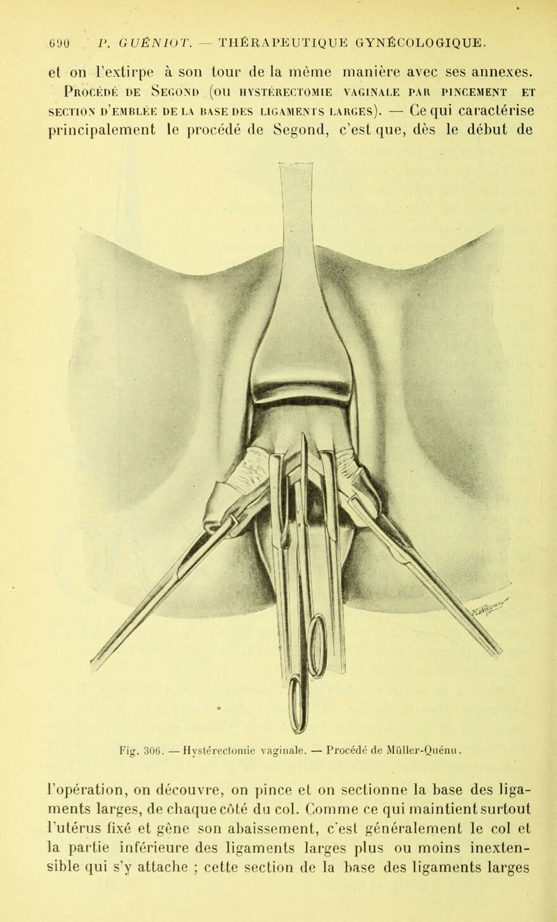 et on l’extirpe à son tour de la même manière avec ses annexes. Procédé de Second (ou hystérectomie vaginale par pincement et section d’emblée de la base des ligaments larges). — Ce qui caractérise principalement le procédé de Segond, c’est que, dès le début de Fig. 306. —Hystérectomie vaginale. — Procédé de Müller-Quénu. l’opération, on découvre, on pince et on sectionne la base des liga- ments larges, de chaque côté du col. Comme ce qui maintient surtout l’utérus fixé et gêne son abaissement, c'est généralement le col et la partie inférieure des ligaments larges plus ou moins inexten- sible qui s’y attache ; cette section de la base des ligaments larges
