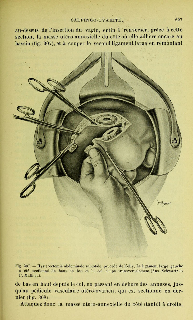 au-dessus de l’insertion du vagin, enfin à renverser, grâce à cette section, la masse utéro-annexielle du coté où elle adhère encore au bassin (fig. 307), et à couper le second ligament large en remontant Fig. 307. — Hystérectomie abdominale subtotale, procédé de Kelly. Le ligament large gauche a été sectionné de haut en bas et le col coupé transversalement (Ans. Schwartz et P. Mathieu). de bas en haut depuis le col, en passant en dehors des annexes, jus- qu’au pédicule vasculaire utéro-ovarien, qui est sectionné en der- nier (fig. 308). Attaquez donc la masse utéro-annexielle du côté (tantôt à droite,
