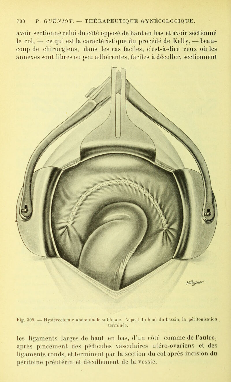 avoir sectionné celui du côté opposé de haut en bas et avoir sectionné le col, — ce qui est la caractéristique du procédé de Kelly, — beau- coup de chirurgiens, dans les cas faciles, c’est-à-dire ceux où les annexes sont libres ou peu adhérentes, faciles à décoller, sectionnent Fig. 309. — Hystérectomie abdominale sublotale. Aspect du fond du bassin, la péritonisation terminée. les ligaments larges de haut en bas, d’un côté comme de l’autre, après pincement des pédicules vasculaires utéro-ovariens et des ligaments ronds, et terminent par la section du col après incision du péritoine préutérin et décollement de la vessie.