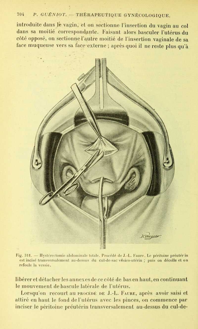 introduite dans le vagin, et on sectionne l’insertion du vagin au col dans sa moitié correspondante. Faisant alors basculer l’utérus du côté opposé, on sectionne l’autre moitié de l’insertion vaginale de sa face muqueuse vers sa face externe ; après quoi il ne reste plus qua Fig. 31 i. — Hystérectomie abdominale totale. Procédé de J.-L. Faure. Le péritoine préutérin est incisé transversalement au-dessus du cul-de-sac vésico-utérin ; puis on décolle et on refoule la vessie. libérer et détacher les annexes de ce côté de bas en haut, en continuant le mouvement de bascule latérale de l’utérus. Lorsqu’on recourt au procédé de J.-L. Faure, après avoir saisi et attiré en haut le fond de l’utérus avec les pinces, on commence par inciser le péritoine préutérin transversalement au-dessus du cul-de-