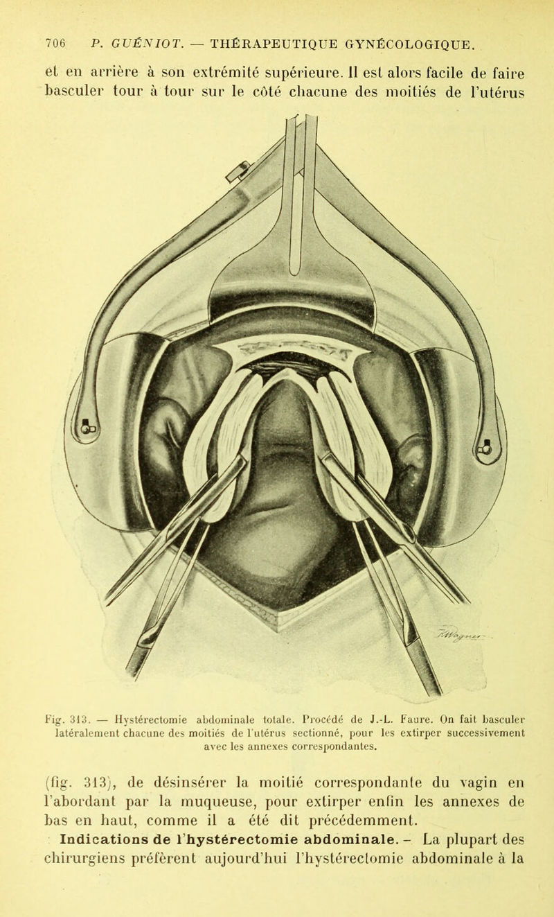 et en arrière à son extrémité supérieure. 11 est alors facile de faire basculer tour à tour sur le côté chacune des moitiés de l’utérus Fig. 313. — Hystérectomie abdominale totale. Procédé de J.-L. Faure. On fait basculer latéralement chacune des moitiés de l’utérus sectionné, pour les extirper successivement avec les annexes correspondantes. (fig. 313), de désinsérer la moitié correspondante du vagin en l’abordant par la muqueuse, pour extirper enfin les annexes de bas en haut, comme il a été dit précédemment. Indications de 1 hystérectomie abdominale. - La plupart des chirurgiens préfèrent aujourd’hui l’hystérectomie abdominale à la
