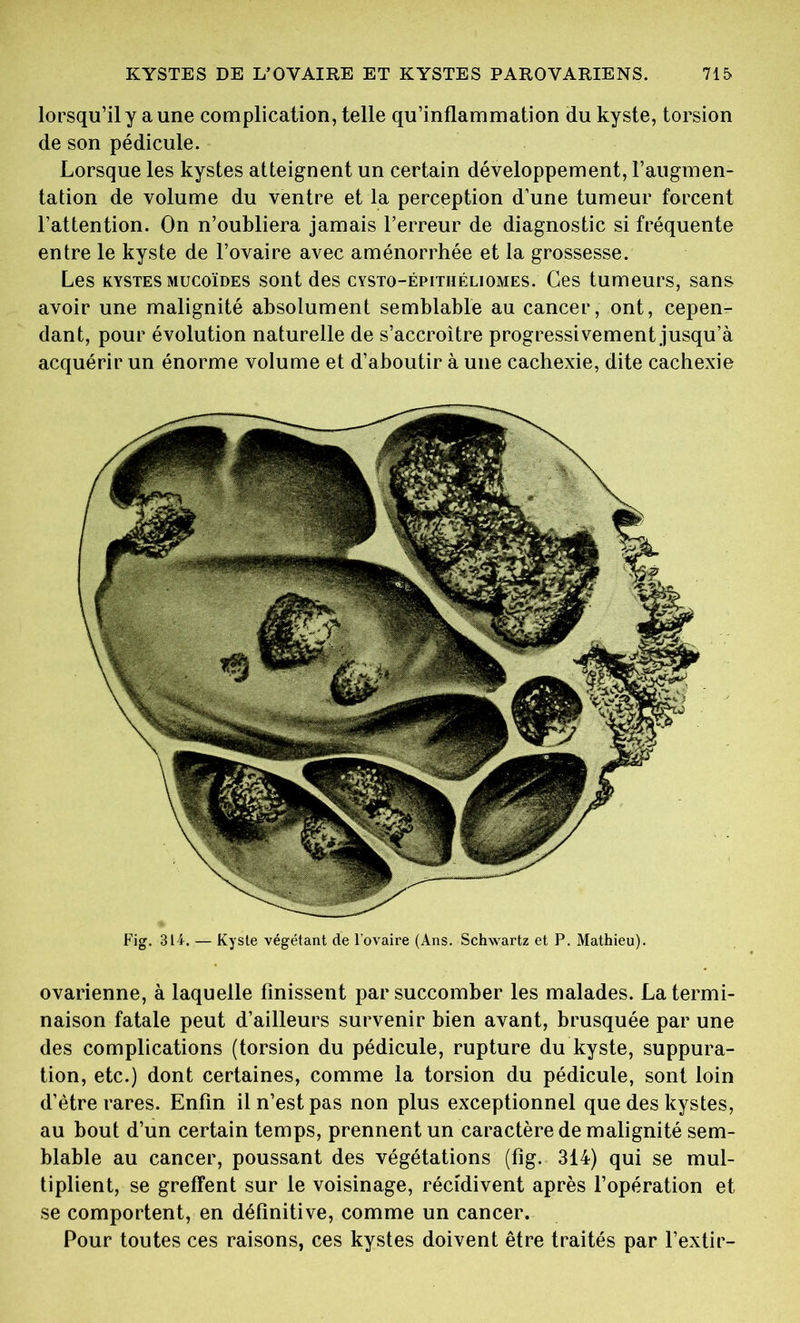 lorsqu’il y aune complication, telle qu’inflammation du kyste, torsion de son pédicule. Lorsque les kystes atteignent un certain développement, l’augmen- tation de volume du ventre et la perception d’une tumeur forcent l’attention. On n’oubliera jamais l’erreur de diagnostic si fréquente entre le kyste de l’ovaire avec aménorrhée et la grossesse. Les kystes mucoïdes sont des cysto-épithéliomes. Ces tumeurs, sans avoir une malignité absolument semblable au cancer, ont, cepen- dant, pour évolution naturelle de s’accroître progressivement jusqu’à acquérir un énorme volume et d’aboutir à une cachexie, dite cachexie ovarienne, à laquelle finissent par succomber les malades. La termi- naison fatale peut d’ailleurs survenir bien avant, brusquée par une des complications (torsion du pédicule, rupture du kyste, suppura- tion, etc.) dont certaines, comme la torsion du pédicule, sont loin d’ètre rares. Enfin il n’est pas non plus exceptionnel que des kystes, au bout d’un certain temps, prennent un caractère de malignité sem- blable au cancer, poussant des végétations (fig. 314) qui se mul- tiplient, se greffent sur le voisinage, récidivent après l’opération et se comportent, en définitive, comme un cancer. Pour toutes ces raisons, ces kystes doivent être traités par l’extir- Fig. 314. — Kyste végétant de l’ovaire (Ans. Schwartz et P. Mathieu).