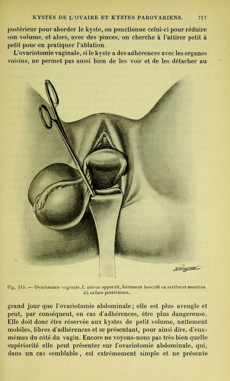 Fig. 315. — Ovariotomie vaginale. L’utérus apparaît, fortement basculé en arrière et montrai» ici sa face postérieure. grand jour que l’ovariotomie abdominale ; elle est plus aveugle et peut, par conséquent, en cas d’adhérences, être plus dangereuse. Elle doit donc être réservée aux kystes de petit volume, nettement mobiles, libres d’adhérences et se présentant, pour ainsi dire, d’eux- mèmes du côté du vagin. Encore ne voyons-nous pas très bien quelle supériorité elle peut présenter sur l’ovariotomie abdominale, qui, dans un cas semblable, est extrêmement simple et ne présente KYSTES DE L’OVAIRE ET KYSTES PAROVARIENS. 717 postérieur pour aborder le kyste, on ponctionne celui-ci pour réduire son volume, et alors, avec des pinces, on cherche à l’attirer petit à petit pour en pratiquer l’ablation. L’ovariotomie vaginale, si le kyste a des adhérences avec les organes voisins, ne permet pas aussi bien de les voir et de les détacher au