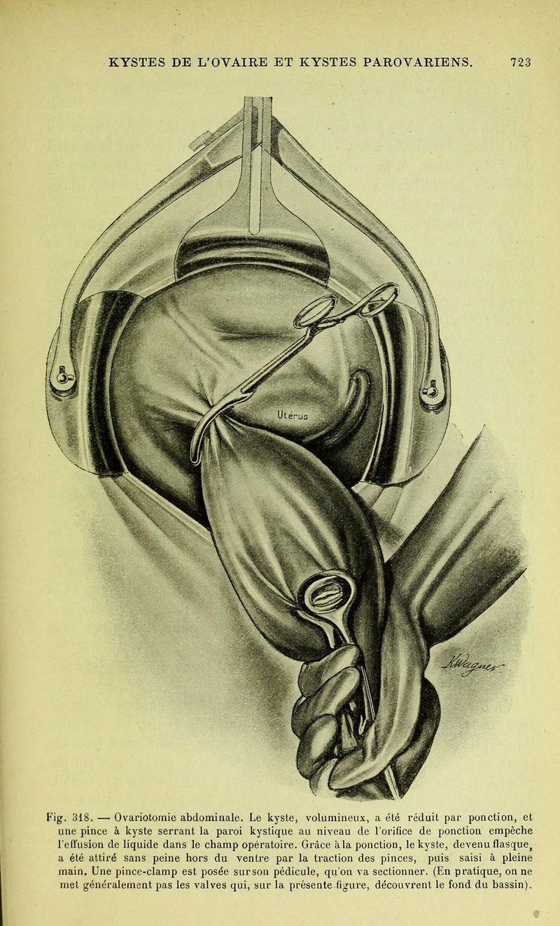 Fig. 318. — Ovariotomie abdominale. Le kyste, volumineux, a été réduit par ponction, et une pince à kyste serrant la paroi kystique au niveau de l’orifice de ponction empêche l’effusion de liquide dans le champ opératoire. Grâce à la ponction, le kyste, devenu flasque, a été attiré sans peine hors du ventre par la traction des pinces, puis saisi à pleine main. Une pince-clamp est posée sur son pédicule, qu’on va sectionner. (En pratique, on ne met généralement pas les valves qui, sur la présente figure, découvrent le fond du bassin).
