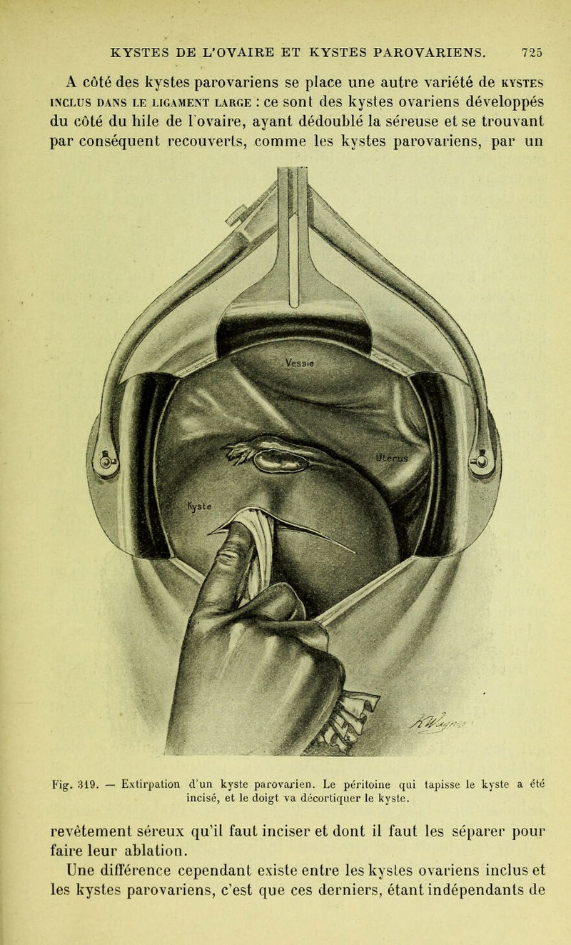 Fig. 319. — Extirpation d’un kyste parovarien. Le péritoine qui tapisse le kyste a été incisé, et le doigt va décortiquer le kyste. revêtement séreux qu’il faut inciser et dont il faut les séparer pour faire leur ablation. Une différence cependant existe entre les kystes ovariens inclus et les kystes parovariens, c’est que ces derniers, étant indépendants de KYSTES DE L’OVAIRE ET KYSTES PAROVARIENS. 725 A côté des kystes parovariens se place une autre variété de kystes iinclus dans le ligament large : ce sont des kystes ovariens développés du côté du hile de l'ovaire, ayant dédoublé la séreuse et se trouvant par conséquent recouverts, comme les kystes parovariens, par un