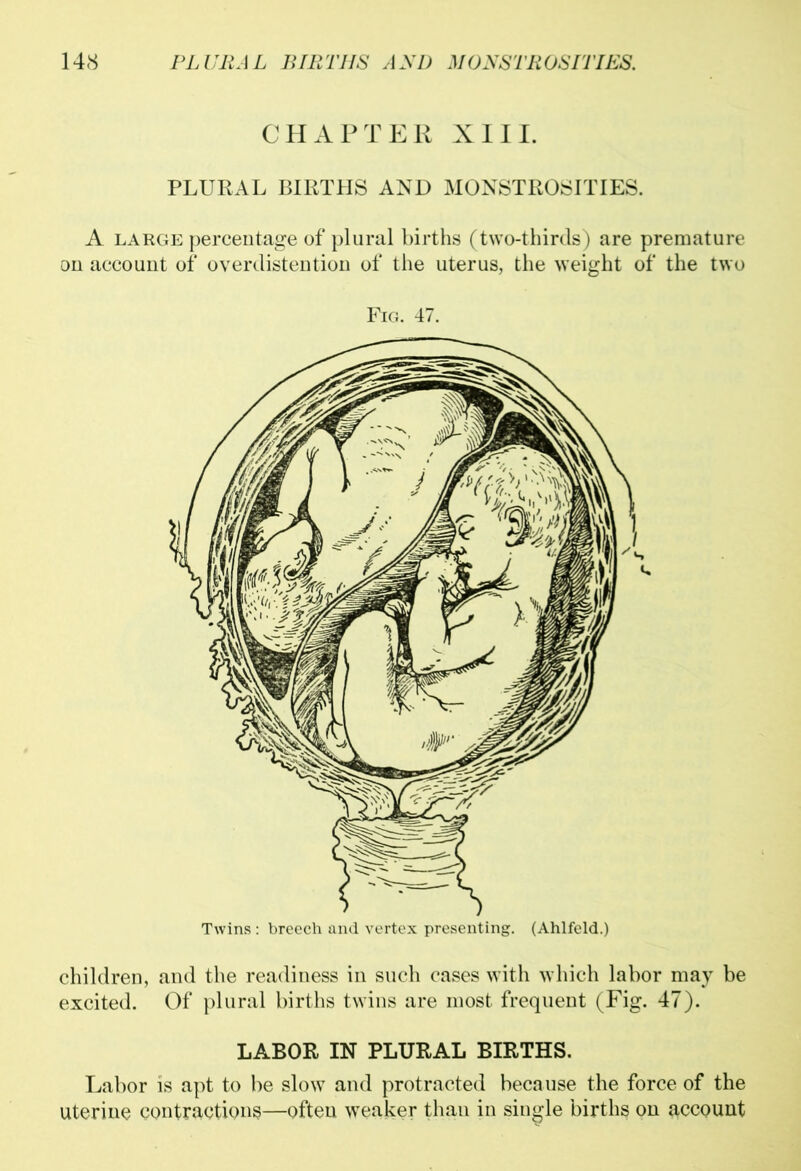 CHAPTER XIII. PLURAL BIRTHS AND MONSTROSITIES. A large percentage of plural births (two-thirds) are premature on account of overdistention of the uterus, the weight of the two Fig. 47. children, and the readiness in such cases with which labor may be excited. Of plural births twins are most frequent (Fig. 47). LABOR IN PLURAL BIRTHS. Labor is apt to be slow and protracted because the force of the uterine contractions—often weaker than in single births on account