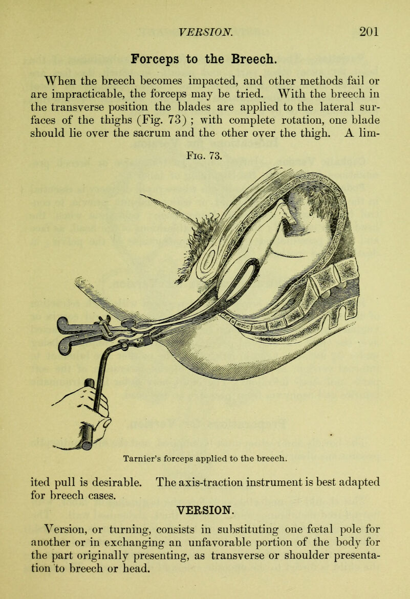 Forceps to the Breech. When the breech becomes impacted, and other methods fail or are impracticable, the forceps may be tried. With the breech in the transverse position the blades are applied to the lateral sur- faces of the thighs (Fig. 73) ; with complete rotation, one blade should lie over the sacrum and the other over the thigh. A lim- Fig. 73. Tarnier’s forceps applied to the breech. ited pull is desirable. The axis-traction instrument is best adapted for breech cases. VERSION. Version, or turning, consists in substituting one foetal pole for another or in exchanging an unfavorable portion of the body for the part originally presenting, as transverse or shoulder presenta- tion to breech or head.