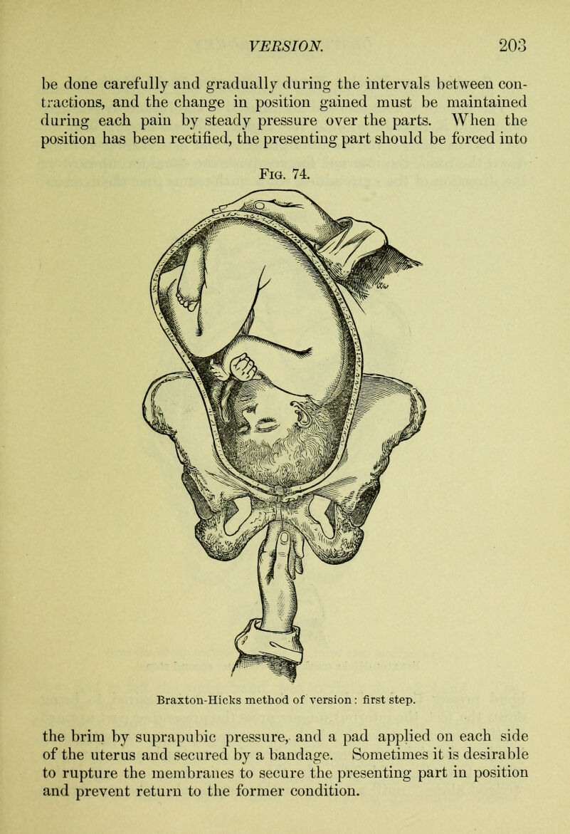 be done carefully and gradually during the intervals between con- tractions, and the change in position gained must be maintained during each pain by steady pressure over the parts. When the position has been rectified, the presenting part should be forced into Fig. 74. the brim by suprapubic pressure, and a pad applied on each side of the uterus and secured by a bandage. Sometimes it is desirable to rupture the membranes to secure the presenting part in position and prevent return to the former condition.