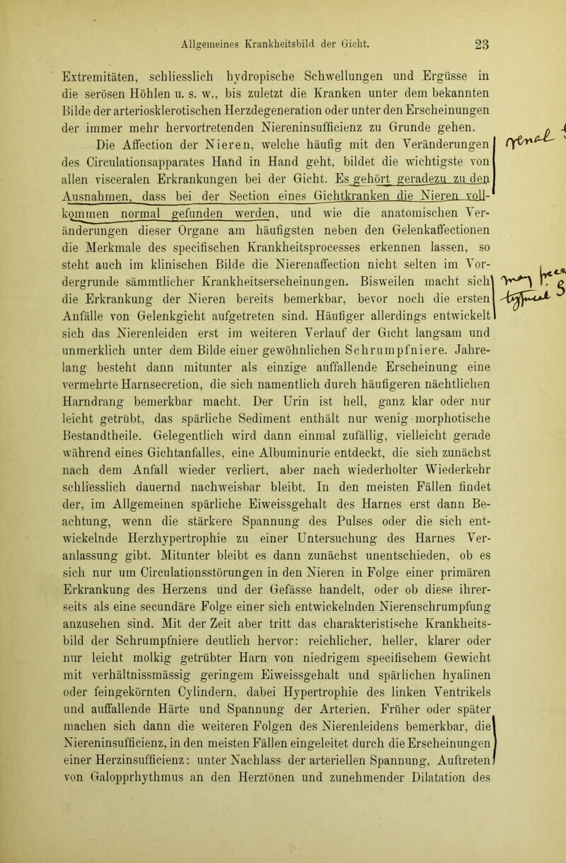 Extremitäten, schliesslich hvdropisehe Schwellungen und Ergüsse in die serösen Höhlen u. s. w., bis zuletzt die Kranken unter dem bekannten Bilde der arteriosklerotischen Herzdegeneration oder unter den Erscheinungen der immer mehr hervortretenden Niereninsufficienz zu Grunde gehen. Die Affection der Nieren, welche häufig mit den Veränderungen des Circulationsapparates Hand in Hand geht, bildet die wichtigste von allen visceralen Erkrankungen bei der Gicht. Es gehört geradezu zu den Ausnahmen, dass bei der Sec-tion eines Gichtkranken die Nieren_AoU- kommen normal gefunden werden, und wie die anatomischen Ver- änderungen dieser Organe am häufigsten neben den Gelenkaffectionen die Merkmale des specifischen Krankheitsprocesses erkennen lassen, so steht auch im klinischen Bilde die Nierenaffection nicht selten im Vor- dergründe sämmtlicher Krankheitserscheinungen. Bisweilen macht sich' die Erkrankung der Nieren bereits bemerkbar, bevor noch die ersten Anfälle von Gelenkgicht aufgetreten sind. Häufiger allerdings entwickelt sich das Nierenleiden erst im weiteren Verlauf der Gicht langsam und unmerklich unter dem Bilde einer gewöhnlichen Schrumpfniere. Jahre- lang besteht dann mitunter als einzige auffallende Erscheinung eine vermehrte Harnsecretion, die sich namentlich durch häufigeren nächtlichen Harndrang bemerkbar macht. Der Urin ist hell, ganz klar oder nur leicht getrübt, das spärliche Sediment enthält nur wenig morphotische Bestandteile. Gelegentlich wird dann einmal zufällig, vielleicht gerade während eines Gichtanfiilles, eine Albuminurie entdeckt, die sich zunächst nach dem Anfall wieder verliert, aber nach wiederholter Wiederkehr schliesslich dauernd nachweisbar bleibt. In den meisten Fällen findet der, im Allgemeinen spärliche Eiweissgehalt des Harnes erst dann Be- achtung, wenn die stärkere Spannung des Pulses oder die sich ent- wickelnde Herzhypertrophie zu einer Untersuchung des Harnes Ver- anlassung gibt. Mitunter bleibt es dann zunächst unentschieden, ob es sich nur um Circulationsstörungen in den Nieren in Folge einer primären Erkrankung des Herzens und der Gefässe handelt, oder ob diese ihrer- seits als eine secundäre Folge einer sich entwickelnden Nierenschrumpfung anzusehen sind. Mit der Zeit aber tritt das charakteristische Krankheits- bild der Schrumpfniere deutlich hervor: reichlicher, heller, klarer oder nur leicht molkig getrübter Harn von niedrigem specifischem Gewicht mit verhältnissmässig geringem Eiweissgehalt und spärlichen hyalinen oder feingekörnten Cylindern, dabei Hypertrophie des linken Ventrikels und auffallende Härte und Spannung der Arterien. Früher oder später machen sich dann die weiteren Folgen des Nierenleidens bemerkbar, die Niereninsufficienz, in den meisten Fällen eingeleitet durch die Erscheinungen einer Herzinsufficienz: unter Nachlass der arteriellen Spannung, Auftreten von Galopprhythmus an den Herztönen und zunehmender Dilatation des y