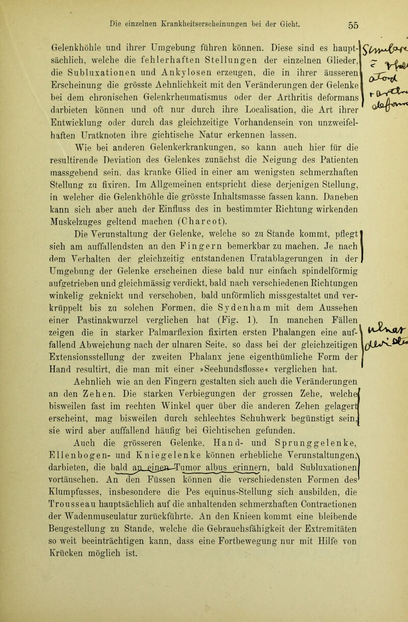 Gelenkhöhle und ihrer Umgebung führen können. Diese sind es haupt- sächlich, welche die fehlerhaften Stellungen der einzelnen Glieder, die Subluxationen und Ankylosen erzeugen, die in ihrer äusseren Erscheinung die grösste Aehnlichkeit mit den Veränderungen der Gelenke bei dem chronischen Gelenkrheumatismus oder der Arthritis deformans darbieten können und oft nur durch ihre Localisation, die Art ihrer Entwicklung oder durch das gleichzeitige Vorhandensein von unzweifel- haften Uratknoten ihre gichtische Natur erkennen lassen. Wie bei anderen Gelenkerkrankungen, so kann auch hier für die resultirende Deviation des Gelenkes zunächst die Neigung des Patienten massgebend sein, das kranke Glied in einer am wenigsten schmerzhaften Stellung zu fixiren. Im Allgemeinen entspricht diese derjenigen Stellung, in welcher die Gelenkhöhle die grösste Inhaltsmasse fassen kann. Daneben kann sich aber auch der Einfluss des in bestimmter Richtung wirkenden Muskelzuges geltend machen (C har cot). Die Verunstaltung der Gelenke, welche so zu Stande kommt, pflegt sich am auffallendsten an den Fingern bemerkbar zu machen. Je nach dem Verhalten der gleichzeitig entstandenen Uratablagerungen in der Umgebung der Gelenke erscheinen diese bald nur einfach spindelförmig aufgetrieben und gleichmässig verdickt, bald nach verschiedenen Eichtungen winkelig geknickt und verschoben, bald unförmlich missgestaltet und ver- krüppelt bis zu solchen Formen, die Sydenliam mit dem Aussehen einer Pastinakwurzel verglichen hat (Fig. 1). In manchen Fällen zeigen die in starker Palmarflexion fixirten ersten Phalangen eine auf- fallend Abweichung nach der ulnaren Seite, so dass bei der gleichzeitigen Extensionsstellung der zweiten Phalanx jene eigentümliche Form der Hand resultirt, die man mit einer »Seehundsflosse« verglichen hat. Aehnlich wie an den Fingern gestalten sich auch die Veränderungen an den Zehen. Die starken Verbiegungen der grossen Zehe, welche bisweilen fast im rechten Winkel quer über die anderen Zehen gelagert erscheint, mag bisweilen durch schlechtes Schuhwerk begünstigt sein, sie wird aber auffallend häufig bei Gichtischen gefunden. Auch die grösseren Gelenke, Hand- und Sprunggelenke, Ellenbogen- und Kniegelenke können erhebliche Verunstaltungen,\ darbieten, die bald ajL-£in£&---Tumor albus erinnern, bald Subluxationen/ Vortäuschen. An den Füssen können die verschiedensten Formen des’ Klumpfusses, insbesondere die Pes equinus-Stellung sich ausbilden, die Trousseau hauptsächlich auf die anhaltenden schmerzhaften Contraetionen der Wadenmusculatur zurückführte. An den Knieen kommt eine bleibende Beugestellung zu Stande, welche die Gebrauchsfähigkeit der Extremitäten so weit beeinträchtigen kann, dass eine Fortbewegung nur mit Hilfe von Krücken möglich ist. t- ow*^*'* //■» /1-itVvyC