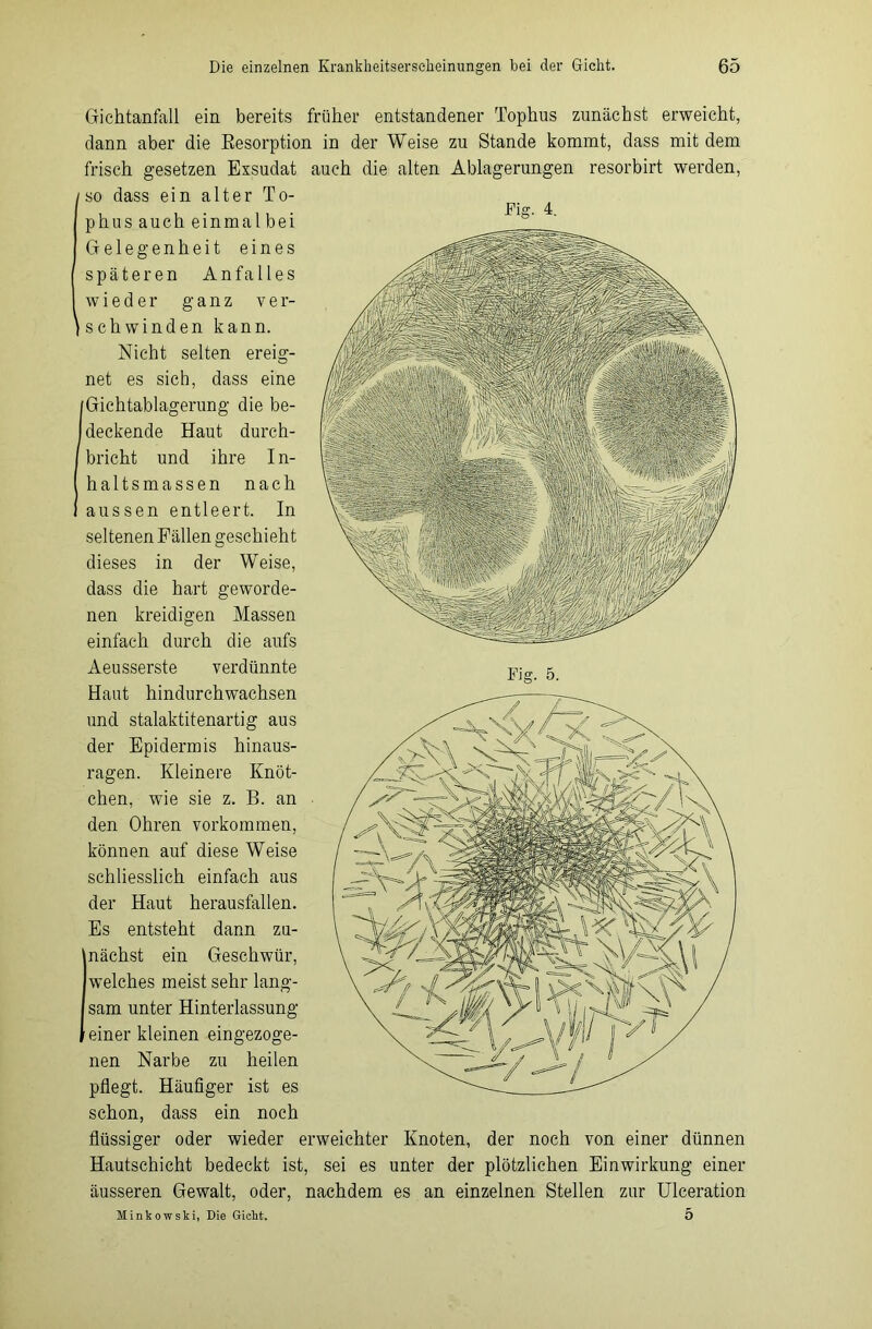 I Fig. 4. Gichtanfall ein bereits früher entstandener Tophus zunächst erweicht, dann aber die Resorption in der Weise zu Stande kommt, dass mit dem frisch gesetzen Exsudat auch die alten Ablagerungen resorbirt werden, so dass ein alter To- phus auch einmal bei Gelegenheit eines späteren Anfalles wieder ganz ver- schwinden kann. Nicht selten ereig- net es sieb, dass eine Gichtablagerung die be- deckende Haut durch- bricht und ihre In- haltsmassen nach aussen entleert. In seltenen Fällen geschieht dieses in der Weise, dass die hart geworde- nen kreidigen Massen einfach durch die aufs Aeusserste verdünnte Haut hindurchwachsen und stalaktitenartig aus der Epidermis hinaus- ragen. Kleinere Knöt- chen, wie sie z. B. an den Ohren Vorkommen, können auf diese Weise schliesslich einfach aus der Haut herausfallen. Es entsteht dann zu- nächst ein Geschwür, welches meist sehr lang- sam unter Hinterlassung einer kleinen eingezoge- nen Narbe zu heilen pflegt. Häufiger ist es schon, dass ein noch flüssiger oder wieder erweichter Knoten, der noch von einer dünnen Hautschicht bedeckt ist, sei es unter der plötzlichen Einwirkung einer äusseren Gewalt, oder, nachdem es an einzelnen Stellen zur Ulceration Minkowski, Die Gicht. 5 Fig. 5.