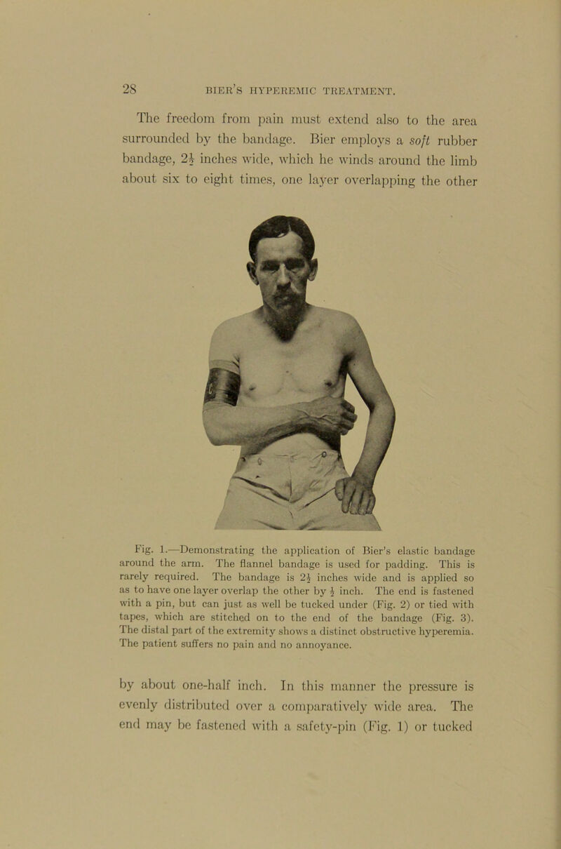 The freedom from pain must extend also to the area surrounded by the bandage. Bier employs a soft rubber bandage, 2\ inches wide, which he winds around the limb about six to eight times, one layer overlapping the other F>g- 1-—Demonstrating the application of Bier’s elastic bandage around the arm. The flannel bandage is used for padding. This is rarely required. The bandage is 2h inches wide and is applied so as to have one layer overlap the other by £ inch. The end is fastened with a pin, but can just as well be tucked under (Fig. 2) or tied with tapes, which are stitched on to the end of the bandage (Fig. 3). The distal part of the extremity shows a distinct obstructive hyperemia. The patient suffers no pain and no annoyance. by about one-half inch. In this manner the pressure is evenly distributed over a comparatively wide area. The end may be fastened with a safety-pin (Fig. 1) or tucked