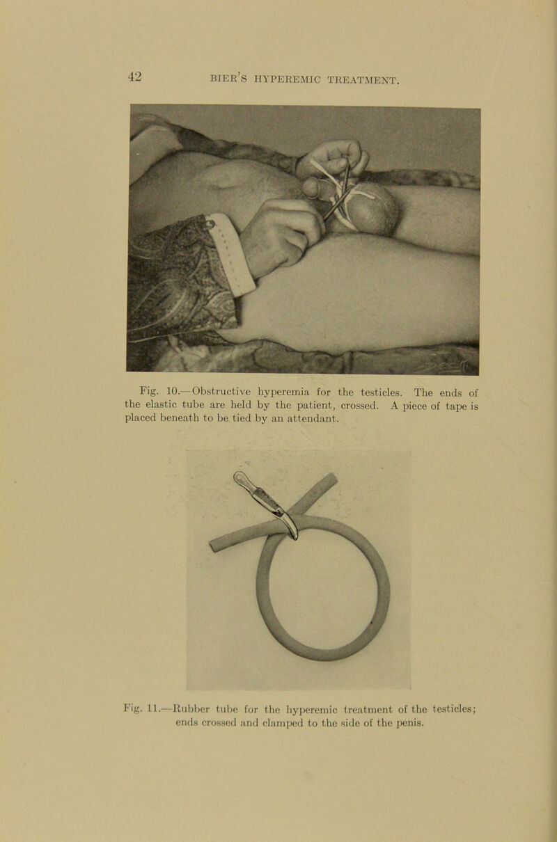 Fig. 10.—Obstructive hyperemia for the testicles. The ends of the elastic tube are held by the patient, crossed. A piece of tape is placed beneath to be tied by an attendant. Fig. 11.—Rubber tube for the hyperemic treatment of the testicles; ends crossed and clamped to the side of the penis.