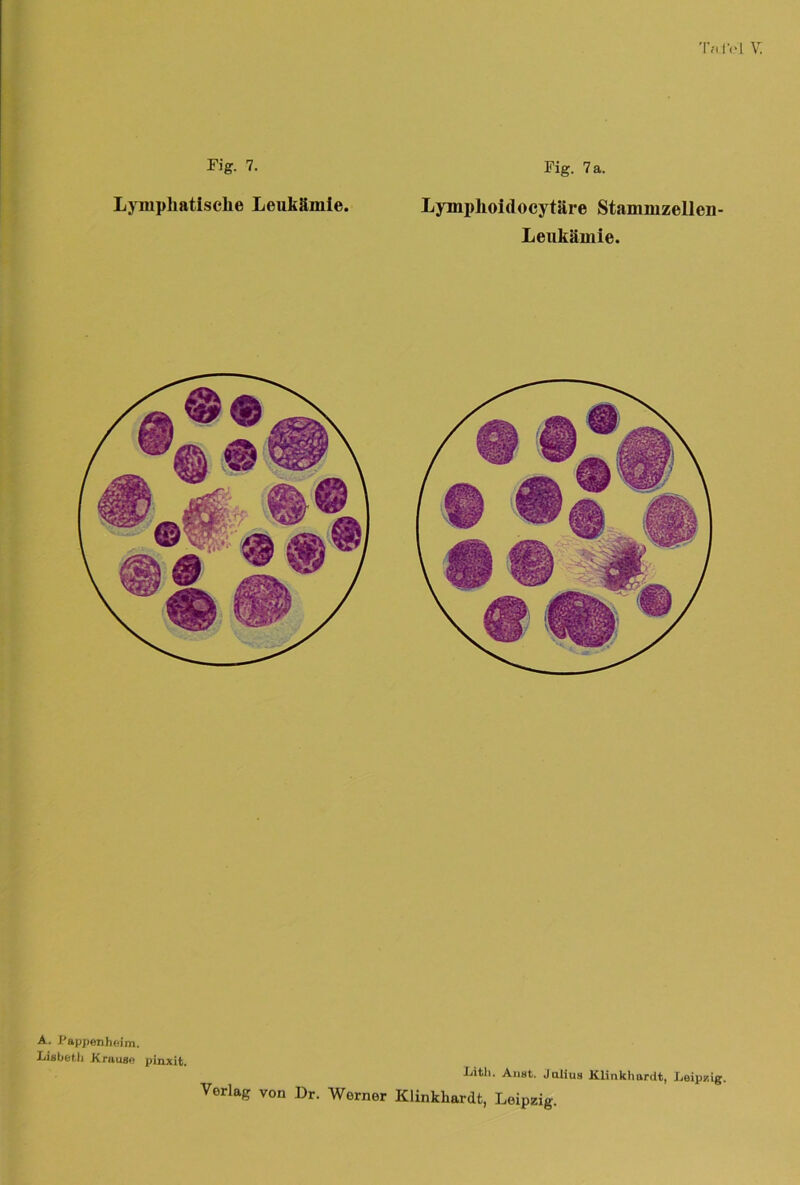 ThI'H V Fig. 7. Lymphatische Leukämie. Fig. 7 a. Lymplioidocytäre Stammzelleii- Leukämie. mm A. Pappenhnim. Lisbeth Krause pinxit. Litli. Aust. Julius Klinkhardt, Leipzig.