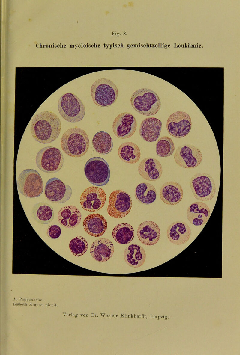Chronische myeloische typisch gemischtzclligc Leukämie A. Pappen heim. Lieheth Krause, pincit.