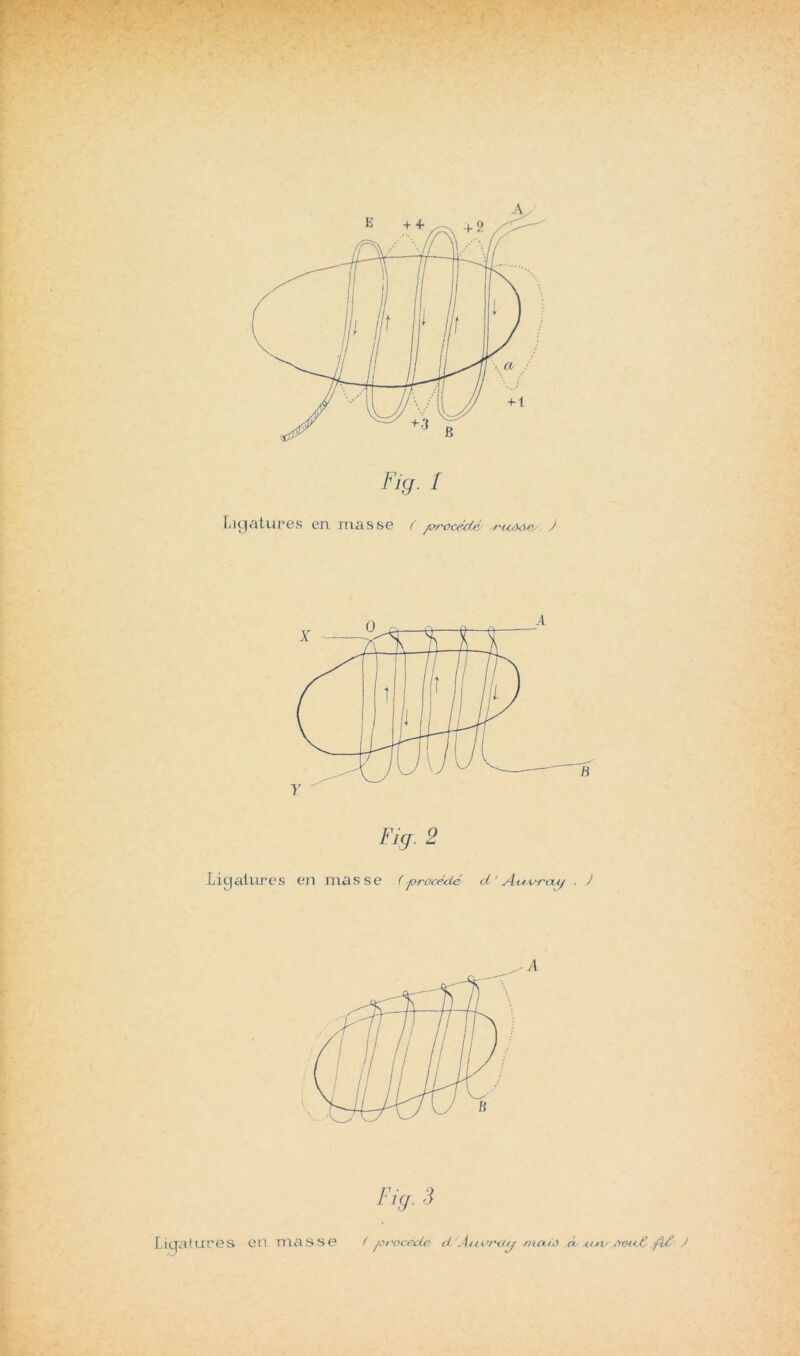F,g . 2 Ligcdtir-es en masse (procé^ié d ' A.-u v~rxxi^ ) Fiff 3 Licfatures en masse ^ pi'océdc d Aiivraij d un^ J