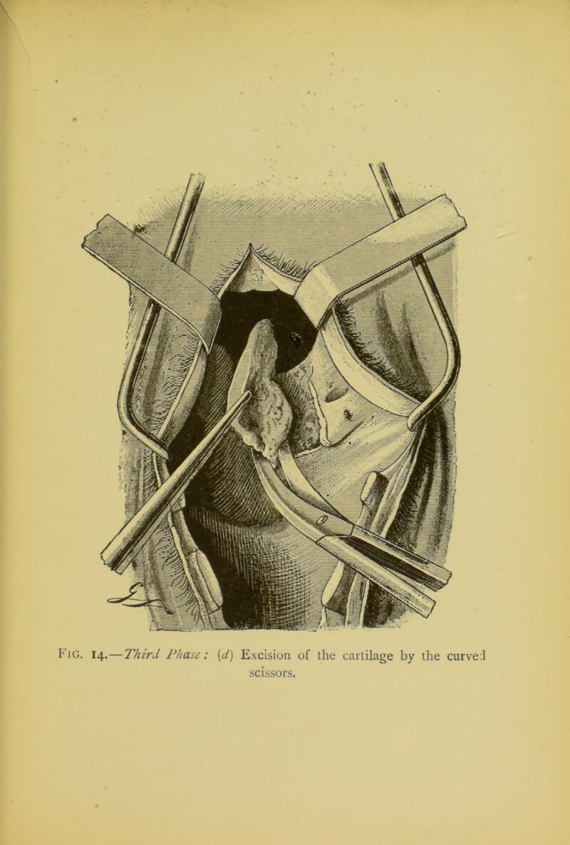 Fig. 14.—Third Phase; (d) Excision of the cartilage by the curved scissors.