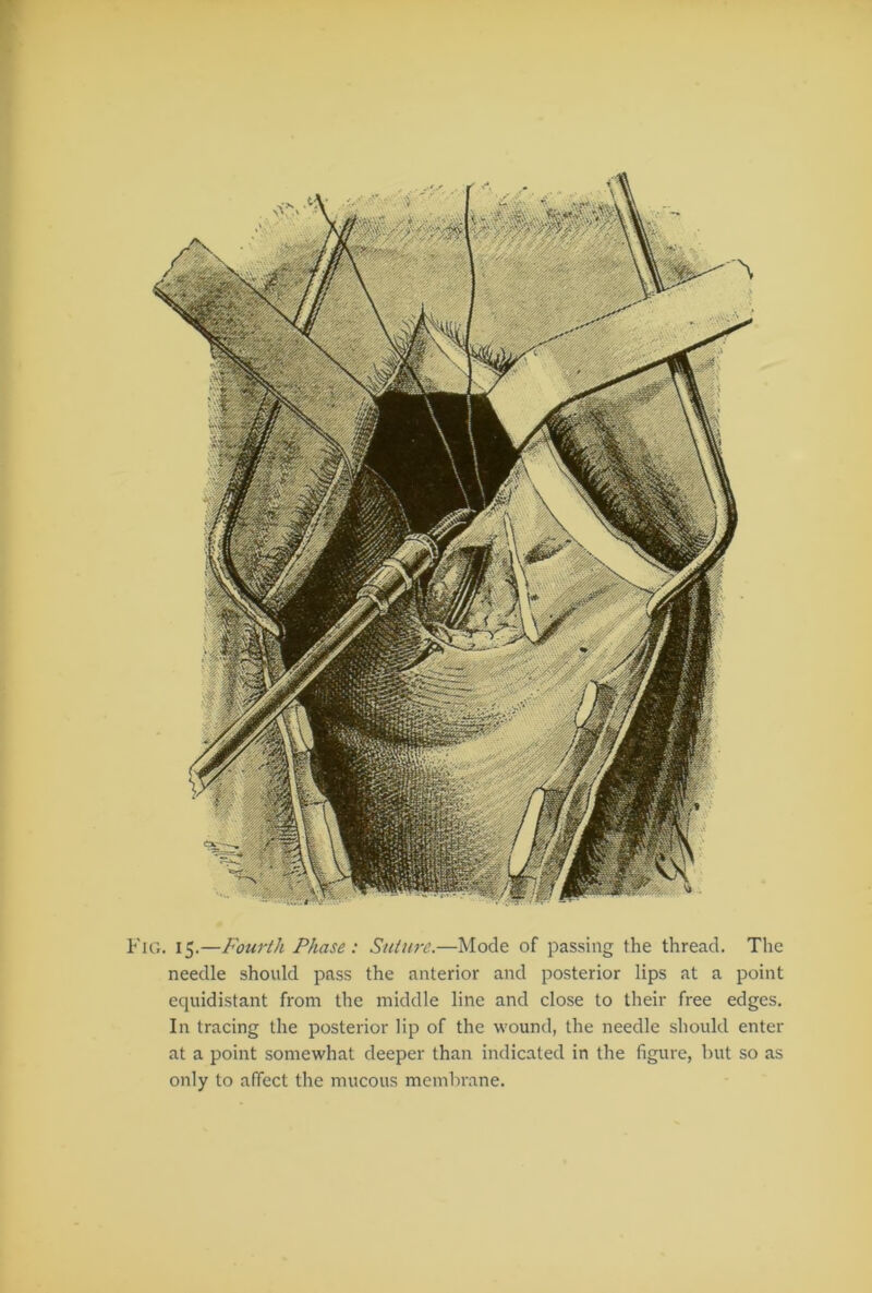 Fig. 15.—Fourth Phase : Suture.—Mode of passing the thread. The needle should pass the anterior and posterior lips at a point equidistant from the middle line and close to their free edges. In tracing the posterior lip of the wound, the needle should enter at a point somewhat deeper than indicated in the figure, but so as only to affect the mucous membrane.