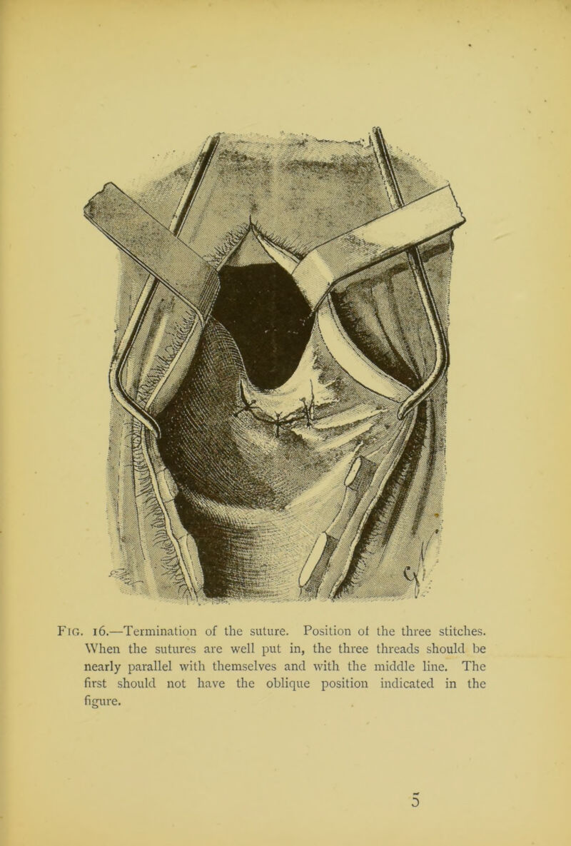 Fig. 16.—Termination of the suture. Position of the three stitches. When the sutures are well put in, the three threads should be nearly parallel with themselves and with the middle line. The first should not have the oblique position indicated in the figure.