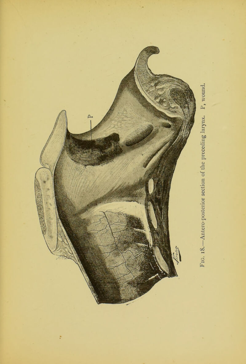 Fig. 18.—Anteroposterior section of the preceding larynx. P, wound.