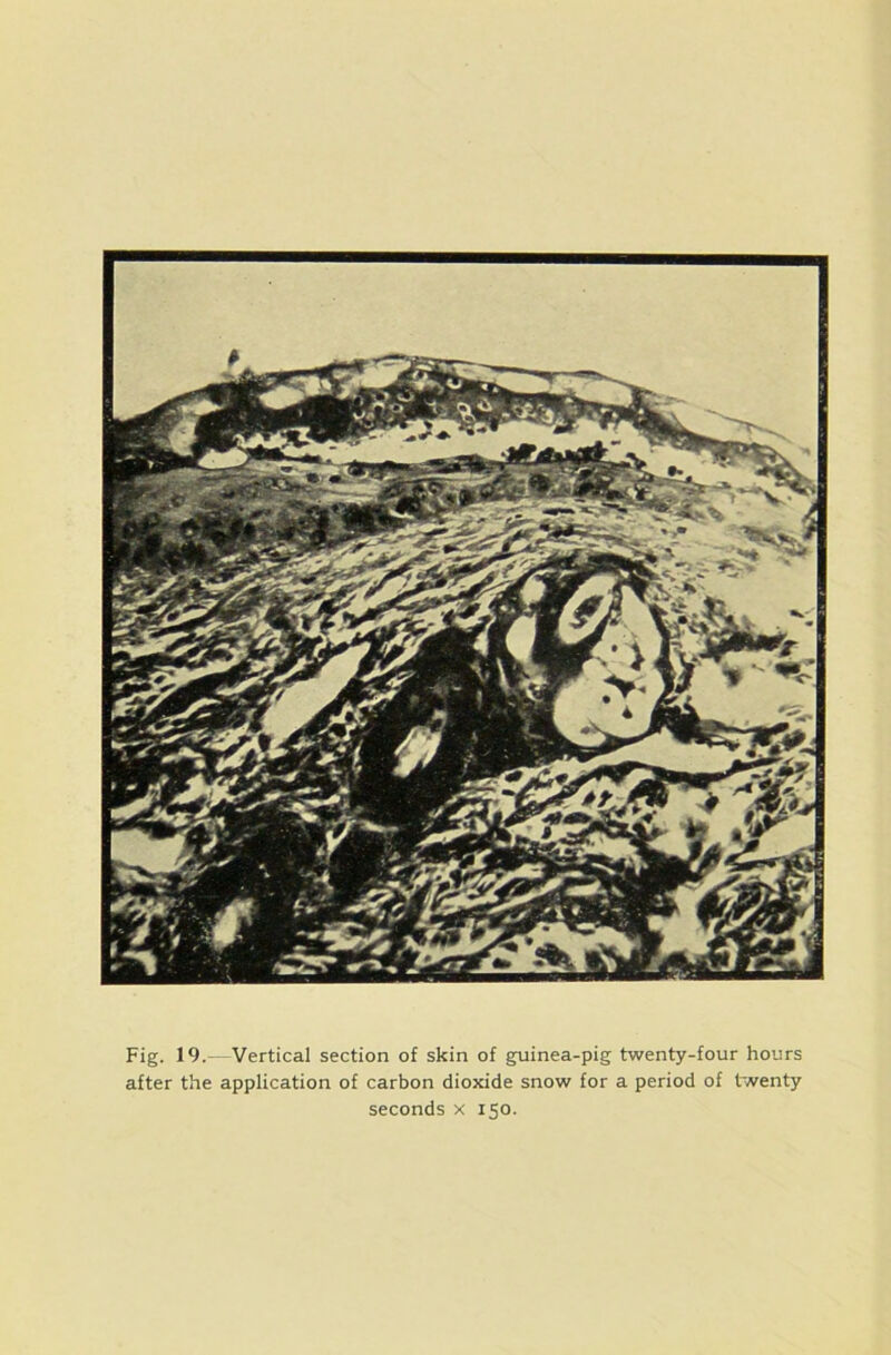 Fig. 19.- Vertical section of skin of guinea-pig twenty-four hours after the application of carbon dioxide snow for a period of twenty