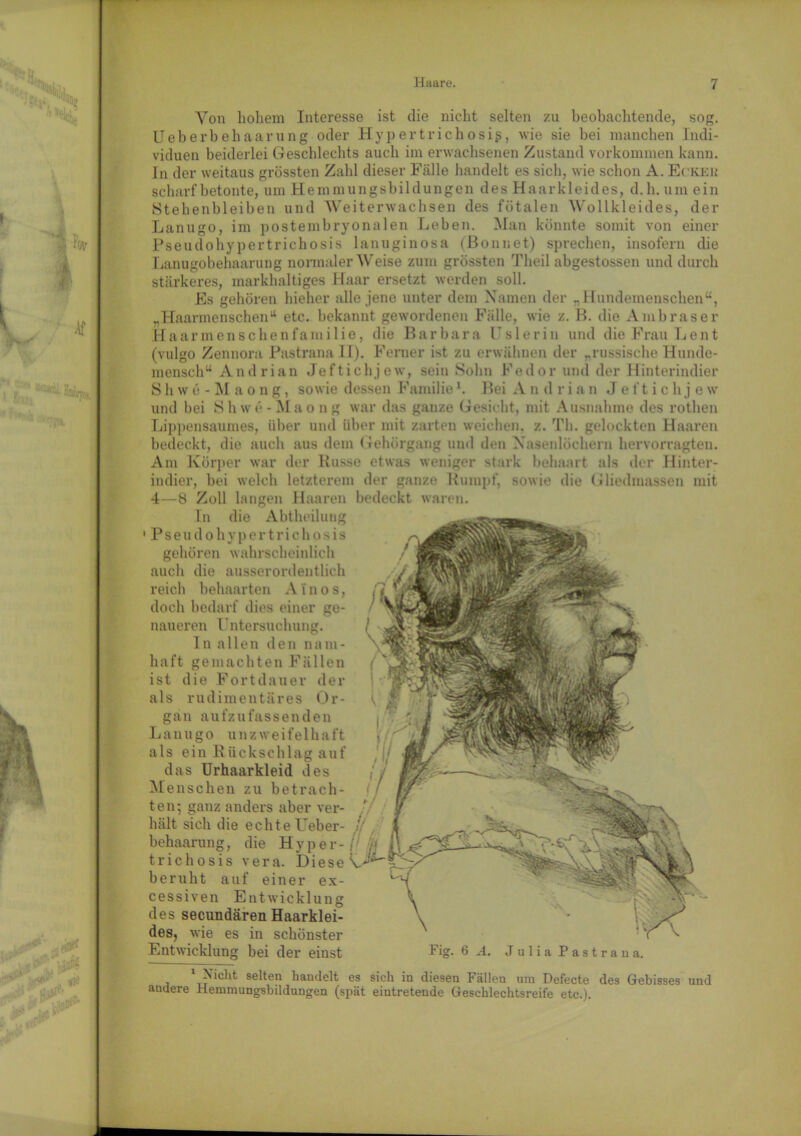 Von hohem Interesse ist die nicht selten zu beobachtende, sog. Ueberbehaarung oder Hypertrichosig, wie sie bei manchen Indi- viduen beiderlei Geschlechts auch im erwachsenen Zustand Vorkommen kann. In der weitaus grössten Zahl dieser Fälle handelt es sich, wie schon A. Ecke« scharf betonte, um Hemmungsbildungen des Haarkleides, d.h.um ein Stehenbleiben und Weiterwachsen des fötalen Wollkleides, der Lanugo, im postembryonalen Leben. Man könnte somit von einer Pseudohypertricbosis lanuginosa (Bonnet) sprechen, insofern die Lanugobehaarung normaler Weise zum grössten Theil abgestossen und durch stärkeres, markhaltiges Haar ersetzt werden soll. Es gehören hieher alle jene unter dem Namen der „Hundemenschen“, „Haarmenschen“ etc. bekannt gewordenen Fälle, wie z. B. die Ambraser Haarmenschenfamilie, die Barbara Uslerin und die Frau Lent (vulgo Zennora Pastrana IL). Ferner ist zu erwähnen der „russische Hunde- mensch“ Andrian Jeftichjew, sein Sohn Fedor und der Hinterindier S h w e - M a o ng, sowie dessen Familiel. Bei A n d r i a n Jeftichje w und bei S h w e - Ma o n g war das ganze Gesicht, mit Ausnahme des rothen Lippensaumes, über und über mit zarten weichen, z. Th. gelockten Haaren bedeckt, die auch aus dem Gehörgang und den Nasenlöchern hervorragten. Am Körper war der Russe etwas weniger stark behaart als der Hinter- indier, bei welch letzterem der ganze Rumpf, sowie die Gliedmassen mit 4—8 Zoll langen Haaren bedeckt waren. In die Abtheilung •Pseudohypertricbosis gehören wahrscheinlich auch die ausserordentlich reich behaarten A i n o s, doch bedarf dies einer ge- naueren Untersuchung. ln allen den nam- haft gemachten Fällen ist die Fortdauer der als rudimentäres Or- gan aufzufassenden Lanugo u n z w e i f e 1 h a ft als ein Rückschlag auf das Urhaarkleid des Menschen zu betrach- ten; ganz anders aber ver- hält sich die echte Ueber- behaarung , die Hyper- trichosis vera. Diese N beruht auf einer ex- cessiven Entwicklung des secundären Haarklei- des, wie es in schönster Entwicklung bei der einst Fig- 6 A. Julia Pastrana. 1 Nicht selten handelt es sich in diesen Fällen um Defecte des Gebisses und andere Hemmungsbildungen (spät eintretende Geschlechtsreife etc.).