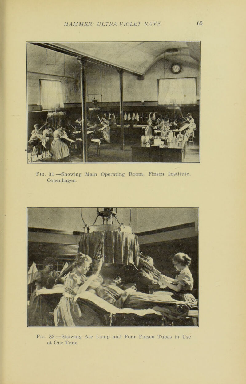 Fig. 31 —Showing Main Operating Room, Finsen Institute, Copenhagen. Fig. 32.—Showing Arc Lamp and Four Finsen Tubes in Use at One Time.