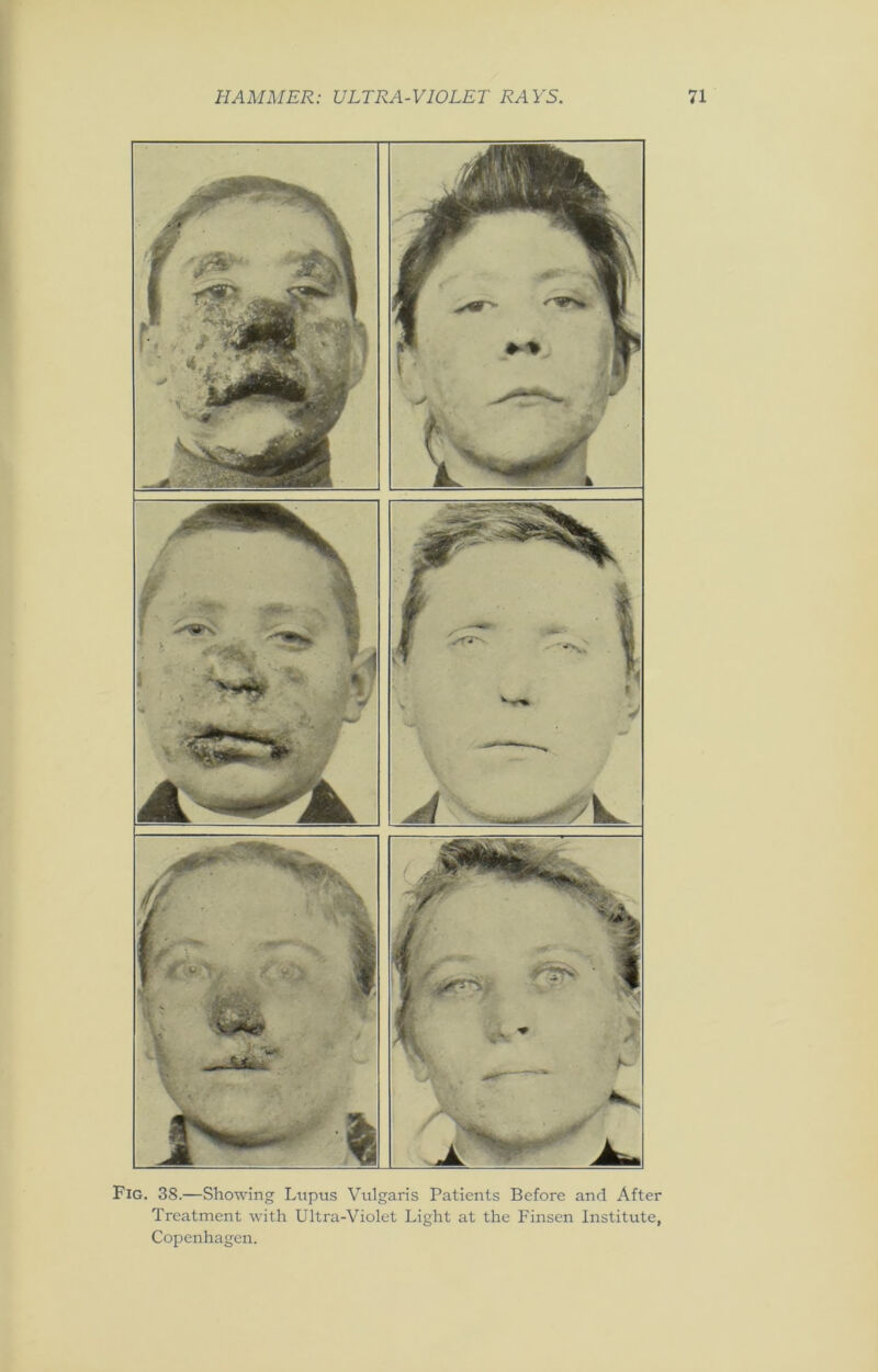 Fig. 38.—Showing Lupus Vulgaris Patients Before and After Treatment with Ultra-Violet Light at the Finsen Institute, Copenhagen.