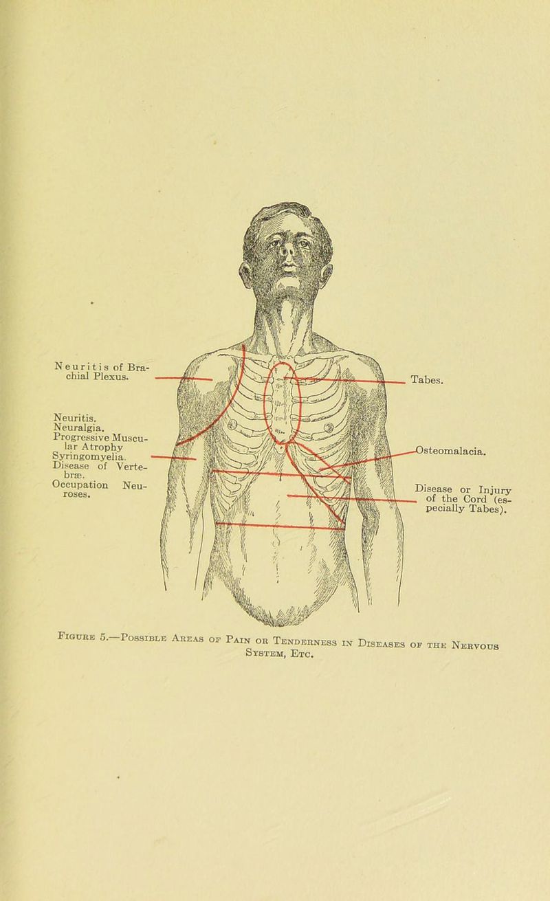 Neuritis of Bra- chial Plexus. Neuritis. Neuralgia. Progressive Muscu- lar Atrophy Syringomyelia. Disease of Verte- bra;. Occupation Neu- roses. Tabes. Disease or Injury of the Cord (es- pecially Tabes). in Diseases op the Nervous