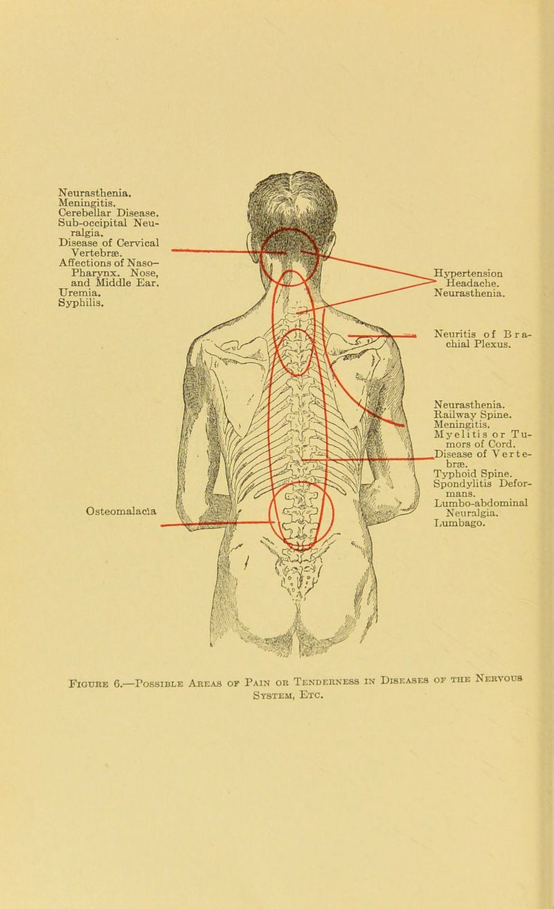 Neurasthenia. Meningitis. Cerebellar Disease. Sub-occipital Neu- ralgia. Disease of Cervical Vertebrae. Affections of Naso- pharynx. Nose, and Middle Ear. Uremia. Syphilis. Osteomalacia Hypertension Headache. Neurasthenia. Neuritis of Bra- chial Plexus. Neurasthenia. Kailway Spine. Meningitis. Myelitis or Tu- mors of Cord. of Verte- brae. Typhoid Spine. Spondylitis Defor- mans. Lumbo-abdominal Neuralgia. Lumbago. Figure 6.—Possible Areas of Pain or Tenderness in Diseases of the Nervous