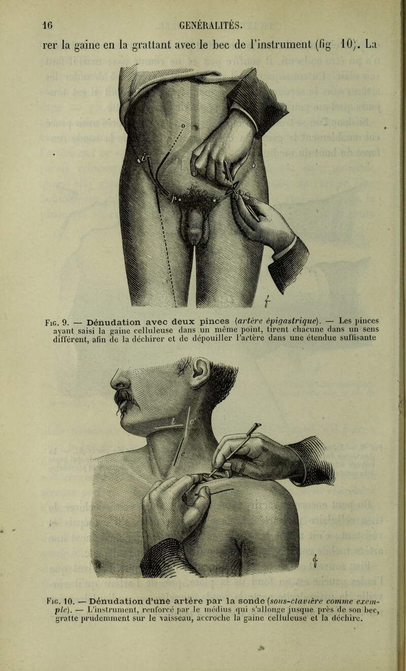 rer la gaine en la grattant avec le l3ec de l’instrument (fig 10). La Fig. 9. — Dénudation avec deux pinces {artère épigastriqtie). — Les pinces ayant saisi la gaine celluleuse dans un même point, tirent chacune dans un sens différent, afin de la déchirer et de dépouiller l’artère dans une étendue suffisante Fjg. 10. — Dénudation d’une artère par la sonde [sous-clavière comme exem- ple). — L’instrument, renforcé par le médius (jui s’allonge jusque près do son hec, gratte pnulemmcnt sur le vaisseau, accroche la gaine celluleuse et la déchire.