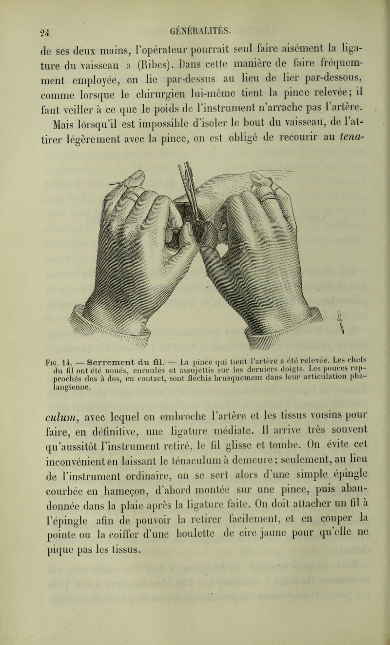 de ses deux mains, l’opérateur pourrait seul faire aisément la liga- ture du vaisseau )) (Ribes). Dans cette manière de faire fréquem- ment employée, on lie par-dessus au lieu de lier par-dessous, comme lorsque le chirurgien lui-même tient la pince relevée; il faut veiller à ce que le poids de rinstrument n’arrache pas l’artère. Mais lorsqu’il est impossible d’isoler le bout du vaisseau, de 1 at- tii’er légèrement avec la pince, on est obligé de recourir au tena- Fig. 14. — Serrement du fil. — La pince qui lient l’artère a été relevée. Les cliels du fil ont été noués, enroulés et assujettis sur les derniers doigts. Les pouces raj)- prochés dos à dos, en contact, sont fléchis brusquenieiu dans leur articulation plia- langienne. culum, avec lequel on embroclie l’artère et les tissus voisins pour faire, en définitive, une ligature médiate. 11 arrive très souvent qu’aussitôt rinstrument retiié, le fil glisse et tombe. On évite cet inconvénient en laissant le téiiaculum a demeure; seulement, au lieu de l’instrument ordinaire, on se sert alors d une simple épingle courbée en hameçon, d’abord montée sur une pince, puis aban- donnée dans la plaie après la ligature faite. On doit attacber un fil a l’épingle afin de pouvoir la retirer facilement, et en couper la pointe ou la coiffer d’une boulette de cire jaune pour qu elle ne pique pas les tissus.