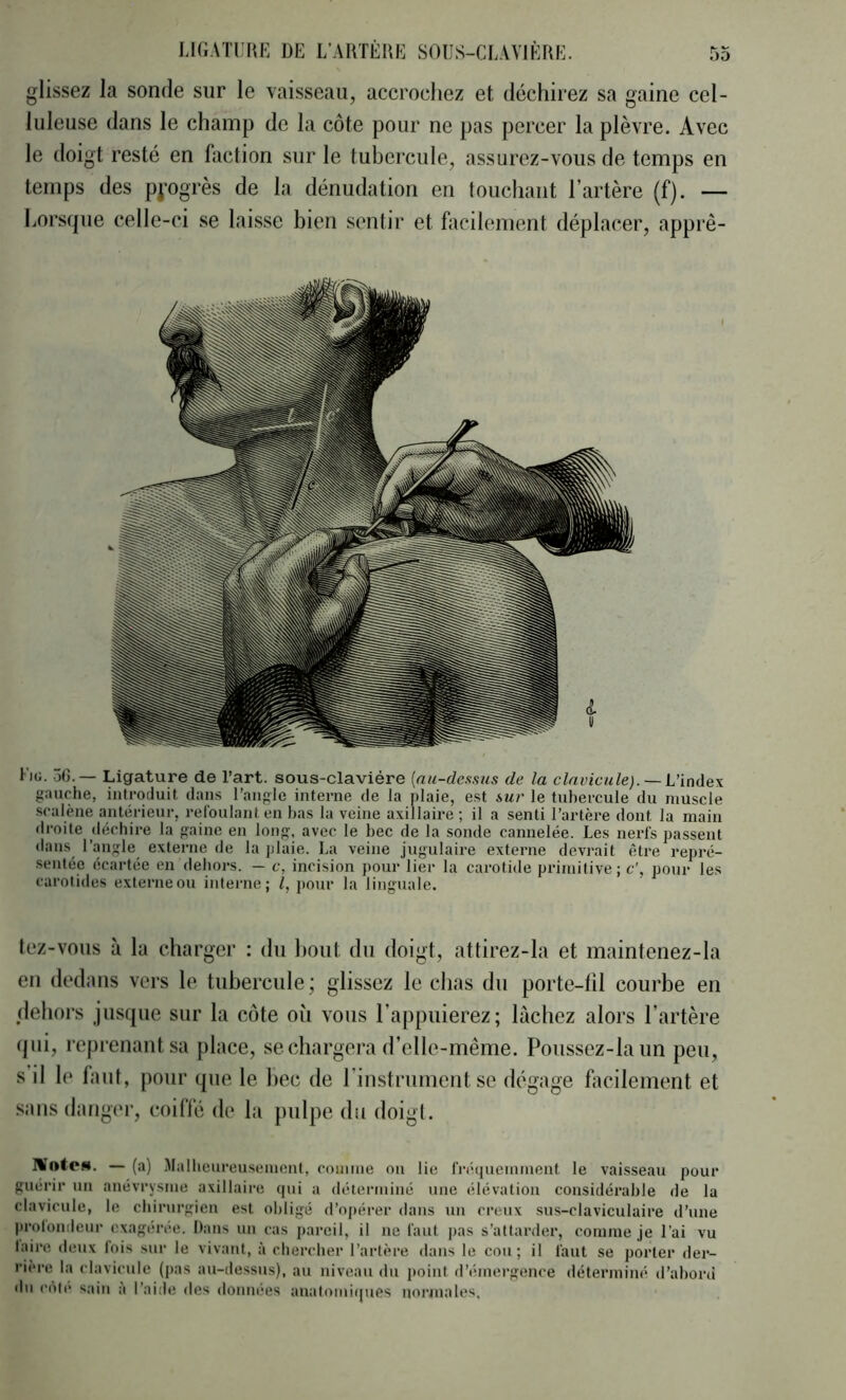 glissez la sonde sur le vaisseau, accrochez et déchirez sa gaine cel- luleuse dans le champ de la côte pour ne pas percer la plèvre. Avec le doigt resté en faction sur le tubercule, assurez-vous de temps en temps des ppgrès de la dénudation en touchant l’artère (f). — horsf|ue celle-ci se laisse bien sentir et facilement dépla(*er, apprê- Fjg. ôG.— Ligature de l’art, sous-claviére [nu-deasus de la clavicule). — L’index gauche, introduit dans l’angle interne de la plaie, est sur le tubercule du muscle scalène antérieur, refoulant en bas la veine axillaire; il a senti l’artère dont la main droite déchire la gaine en long, avec le bec de la sonde cannelée. Les nerfs passent «laiis l’angle externe de la plaie. La veine jugulaire externe devrait être repré- .sentée écartée en dehors. — c, incision pour lier la carotide primitive; c', pour les carotides externeou inteiaie; Z, j)our la linguale. tcz-vous à la charger : du Itout du doigt, attirez-la et maintenez-la en dedans vers le tubercule; glissez le chas du porte-fil courbe en dehors jusque sur la côte oii vous l’appuierez; lâchez alors l’artère tpii, reprenant sa place, se chargera d’elle-même. Poussez-laun peu, s il le faut, pour que le bec de l’instrument se dégage hicilement et .sans danger, coiffé de la jiulpe du doigt. MntcM. — (a) Malheureusement, comme on lie fréquemment le vaisseau pour guérir un anévrysme axillaire qui a déterminé une élévation considérable de la clavicule, le chirurgien est oljligé d’opérer dans un creux sus-claviculaire d’une protouileur exagérée. Dans un cas j)areil, il ne faut pas s’attarder, comme je l’ai vu taire deux lois sur le vivant, à chercher l’artère dans le cou; il faut se porter der- rière la clavicule (pas au-dessus), au niveau du j)oiiit d’émergence déterminé d’abord du côte sain a l’aide des données anatomi(]ues uorjnales.