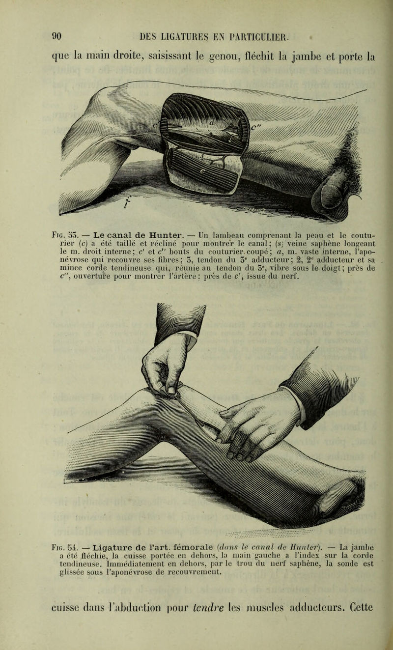 que la main droite, saisissant le genou, flécliit la jambe et porte la Fjg. 55. — Le canal de Hunter. — Un lanibeavi comprenant la peau et le coutu- rier (c) a été taillé et récliné pour nioutrer le canal; (sj veine saphène longeant le ni. droit interne; c' et c bouts du couturier, coupé ; a, m. vaste interne, l’apo- névrose qui recouvre ses fdires; 3, tendon du 3* adducteur; 2, 2' adducteur et sa mince corde tendineuse qui, réunie au tendon du 5°, vibre sous le doigt; près de c”. ouverture pour montrer l’artère; près de c', issue du nerf. Fig. 54. — Ligature de l’art, fémorale (df/ns le canal de Hwiter). — La jambe a été fléchie, la cuisse portée en dehors, la main gauche a l’index sur la corde tendineuse. Immédiatement en dehors, par le trou du nerf saphène, la sonde est glissée sous l’aponévrose de recouvrement. cuisse (buis l’abducTion pour tendre les museJes atidueteurs. Celte