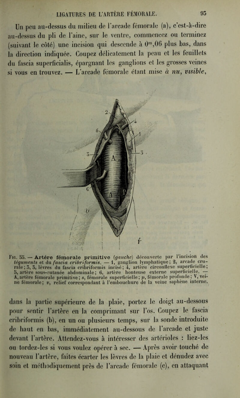 Un peu au-dessus du milieu de l’arcade fémorale (a), c’est-à-dire au-dessus du pli de l’aine, sur le ventre, commencez ou terminez (suivant le côté) une incision qui descende à 0',06 plus bas, dans la direction indiquée. Coupez délicatement la peau et les feuillets du fascia superficialis, épargnant les ganglions et les grosses veines si vous en trouvez. — L’arcade fémorale étant mise à nu, visible. Fifi. 55. — Artère fémorale primitive {gauche] découverte par l’incision des téguments et (\n fascia cribriformis. — 1, ganglion lymphatique; 2, arcade cru- rale; 5, 3, lèvres du fascia cribriformis incisé; 4, artère circonflexe superficielle; 5, artère sous-cutanée abdominale; 6, artère honteuse externe superficielle. A,artère fémorale primitive; *•, fémorale superficielle; p, fémorale profonde ; V, vei- ne fémorale; v, relief correspondant à l’embouchure de la veine saphène interne. dans la partie supérieure de la plaie, portez le doigt au-dessous pour sentir l’artère en la comprimant sur l’os. Coupez le fascia crihrilbrmis (b), en un ou plusieurs temps, sur la sonde introduite de haut en bas, immédiatement au-dessous de l’arcade et juste devant l’artère. Attendez-vous à intéresser des artérioles : liez-les ou tordez-les si vous voulez opérer à sec. — Après avoir touché de nouveau l’artère, faites écarter les lèvres de la plaie et dénudez avec soin et méthodiquement près de l’arcade fémorale (c), en attaquant