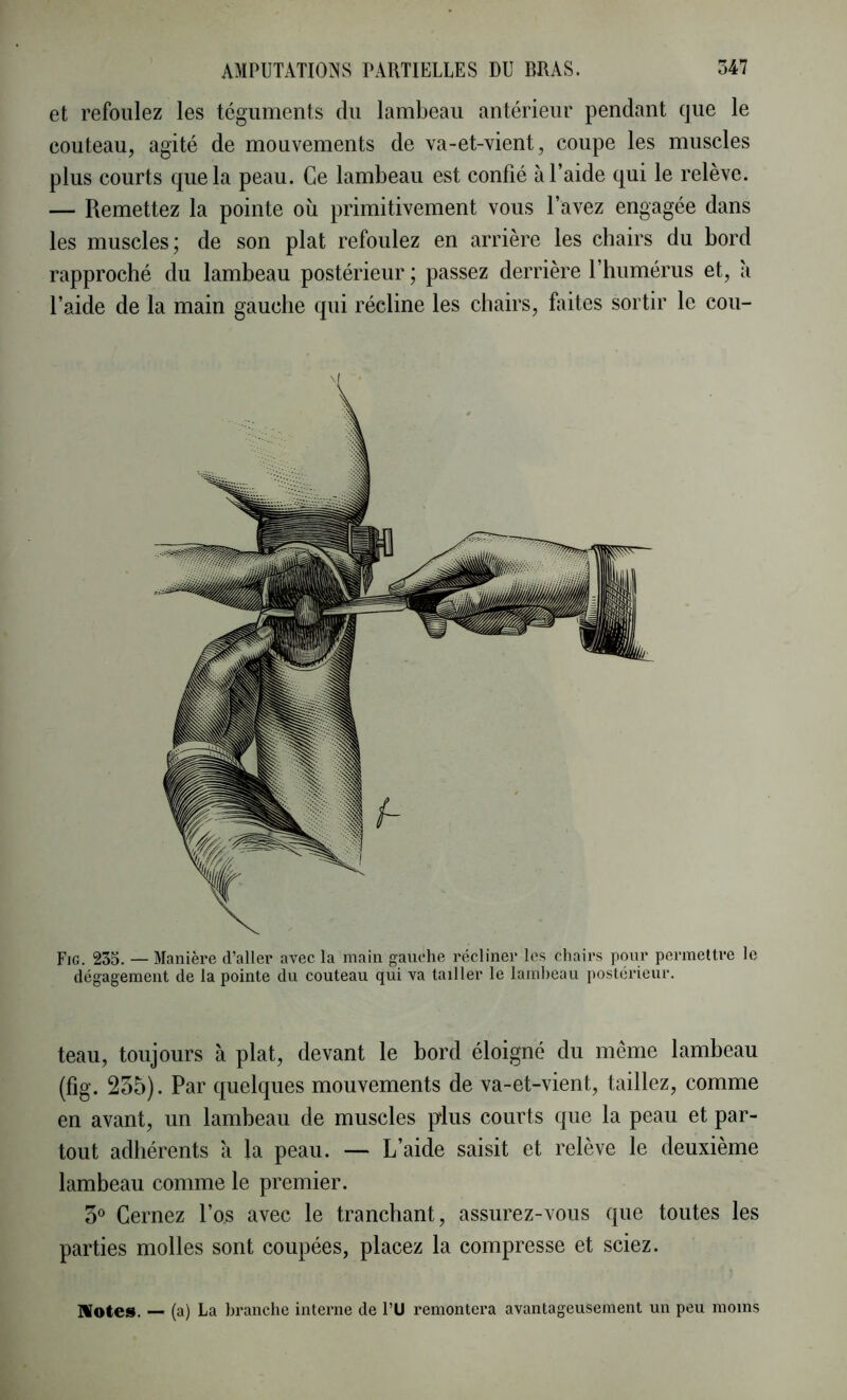 et refoulez les téguments du lambeau antérieur pendant que le couteau, agité de mouvements de va-et-vient, coupe les muscles plus courts que la peau. Ce lambeau est confié à l’aide qui le relève. — Remettez la pointe où primitivement vous l’avez engagée dans les muscles; de son plat refoulez en arrière les chairs du bord rapproché du lambeau postérieur ; passez derrière l’humérus et, à l’aide de la main gauche qui récline les chairs, faites sortir le cou- Fig. 235. — Manière d’aller avec la main gauche récliner les chairs pour permettre le dégagement de la pointe du couteau qui va tailler le lamheau postérieur. teau, toujours à plat, devant le bord éloigné du même lambeau (fig. 255). Par quelques mouvements de va-et-vient, taillez, comme en avant, un lambeau de muscles plus courts que la peau et par- tout adhérents à la peau. — L’aide saisit et relève le deuxième lambeau comme le premier. 5° Cernez l’os avec le tranchant, assurez-vous que toutes les parties molles sont coupées, placez la compresse et sciez. IVotes. — (a) La branche intenie de l’U remontera avantageusement un peu moins