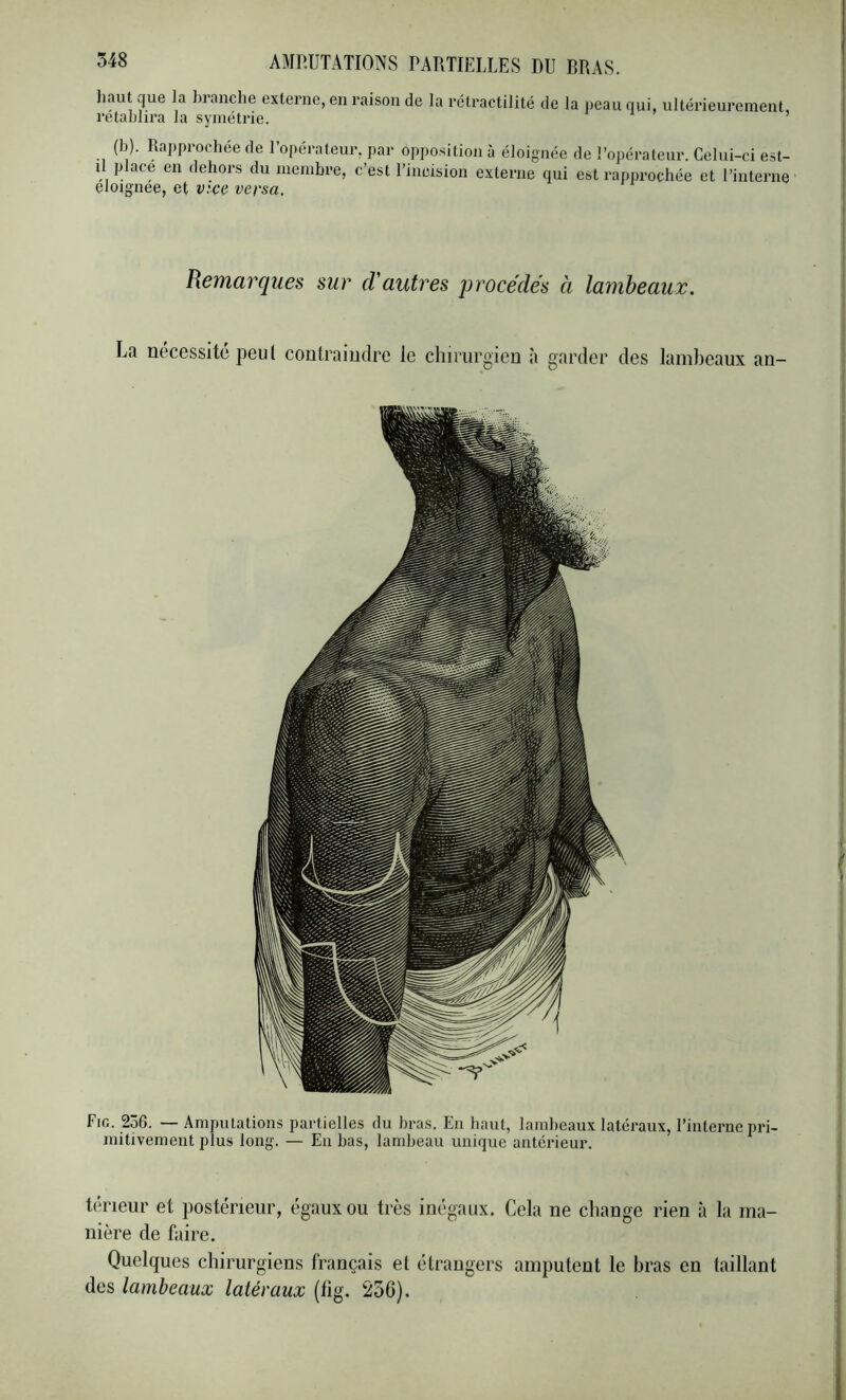 liaut que la hranche externe, en raison de la rétractilité de la i)eau qui, ultérieurement, rétablira la symétrie. (b). Ra])prochée de l’opérateur, par ôpposition à éloignée de l’opérateur. Celui-ci est- il place en dehors du membre, c’est l’incision externe qui est rapprochée et l’interne- eloignee, et v:ce versa. Remarques sur d'autres 'procédés à lambeaux. La nécessite peut contraindre le chirurgien à garder des lambeaux an- Fig. 256. — Amputations partielles du bras. En haut, lambeaux latéraux, l’interne pri- mitivement plus long. — En bas, lambeau unique antérieur. teneur et postérieur, égaux ou très inégaux. Cela ne change rien à la ma- nière de faire. Quelques chirurgiens français et étrangers amputent le bras en taillant des lambeaux latéraux (fig. 256).