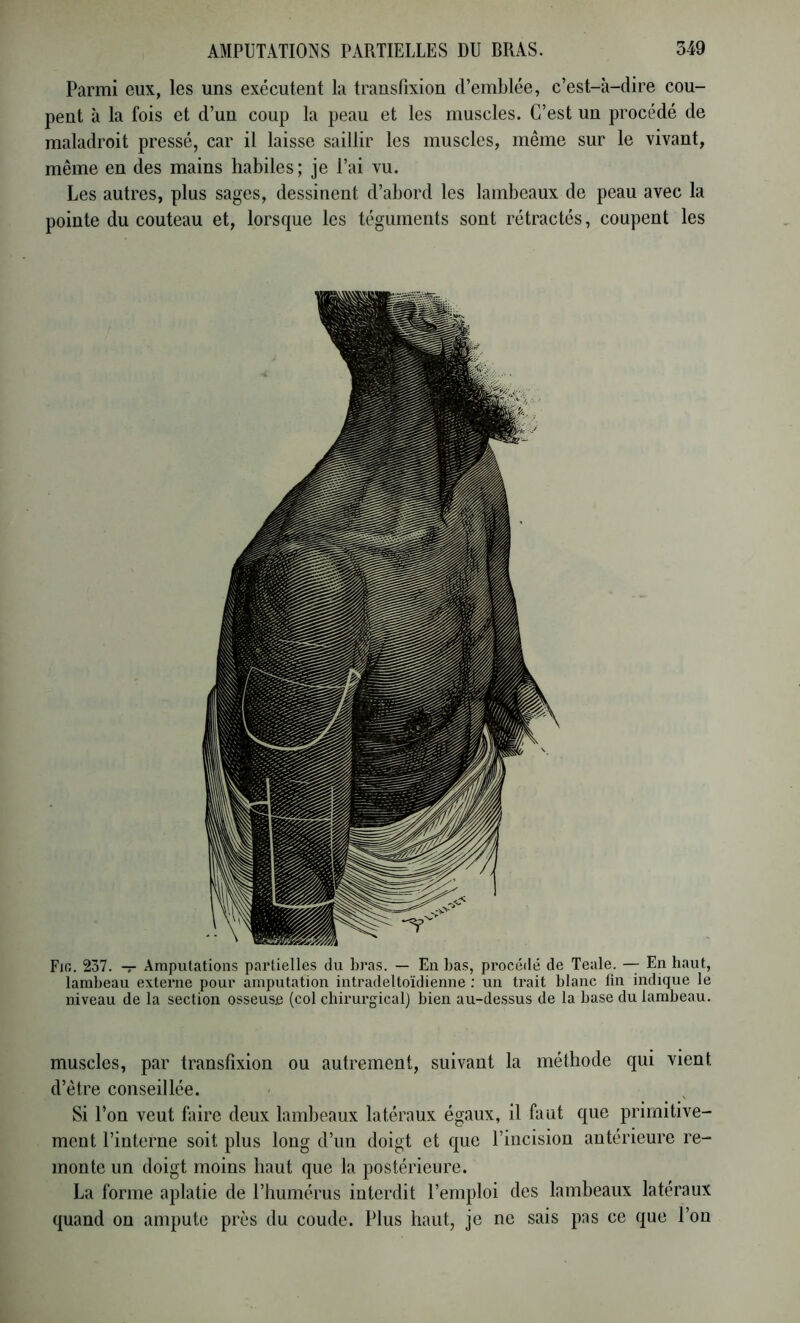 Parmi eux, les uns exécutent la transFixion d’emblée, c’est-à-dire cou- pent à la fois et d’un coup la peau et les muscles. C’est un procédé de maladroit pressé, car il laisse saillir les muscles, même sur le vivant, même en des mains habiles; je l’ai vu. Les autres, plus sages, dessinent d’abord les lambeaux de peau avec la pointe du couteau et, lorsque les téguments sont rétractés, coupent les Fio. 237. -r Amputations partielles du bras. — En bas, procédé de Teale. — En haut, lambeau externe pour amputation intradeltoïdienne : un trait blanc fin indique le niveau de la section osseuse (col chirurgical) bien au-de.ssus de la base du lambeau. muscles, par transfixion ou autrement, suivant la méthode qui vient d’être conseillée. Si l’on veut faire deux lambeaux latéraux égaux, il faut que primitive- ment l’interne soit plus long d’un doigt et que l’incision antérieure re- monte un doigt moins haut que la postérieure. La forme aplatie de l’humérus interdit l’emploi des lambeaux latéraux quand on ampute près du coude. Plus haut, je ne sais pas ce que l’on